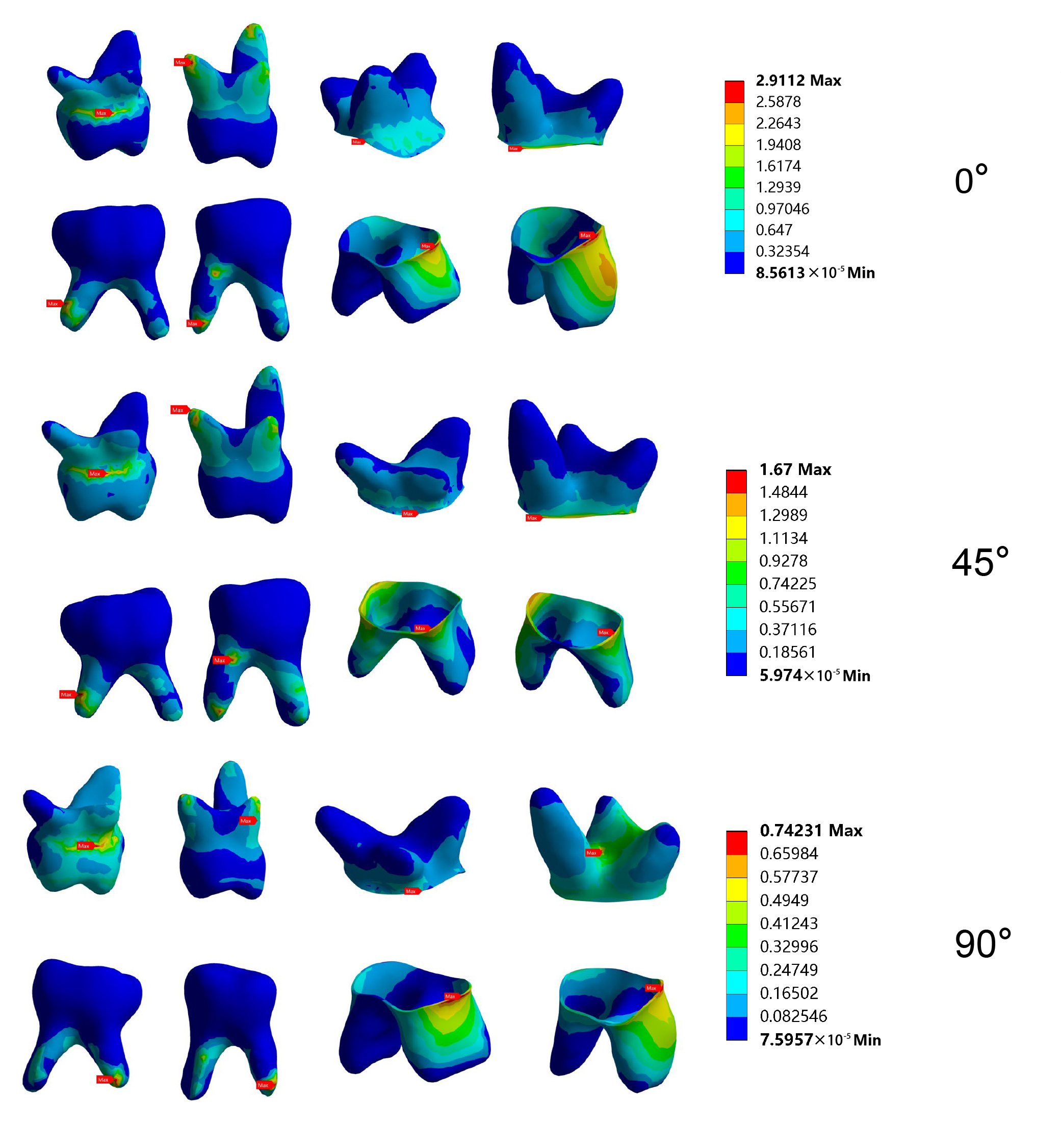 Stress cloud diagram of the group of SSCs 
unrepaired deciduous molars.