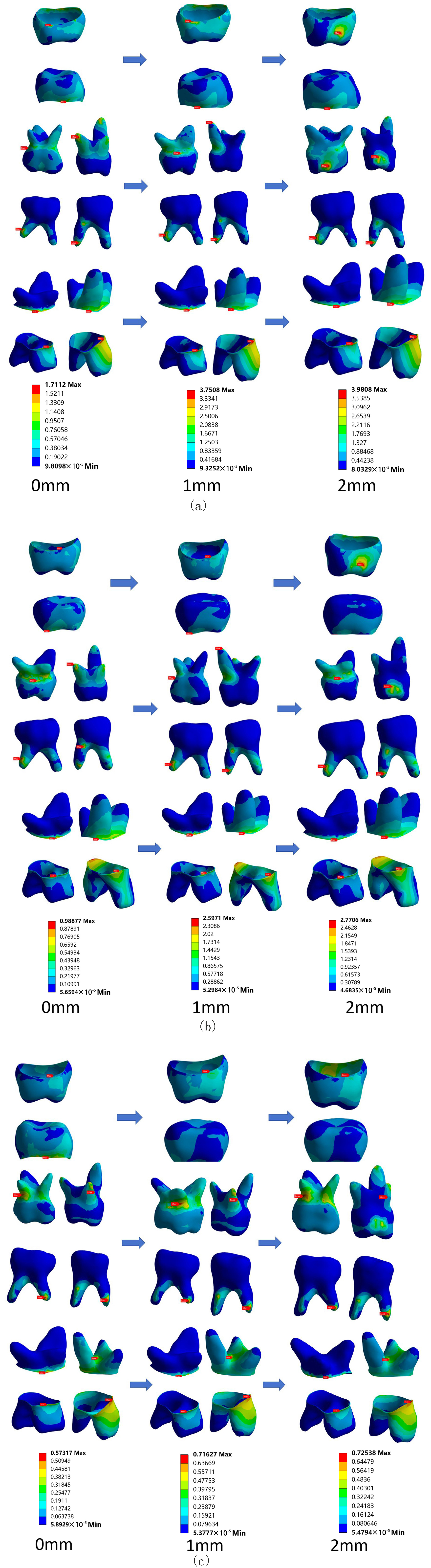 Stress 
nephogram illustrating changes in occlusal height and load angle after SSCs have 
repaired the second deciduous molars on the right maxilla and mandible. (a) 
0°, (b) 45°, (c) 90° Load.