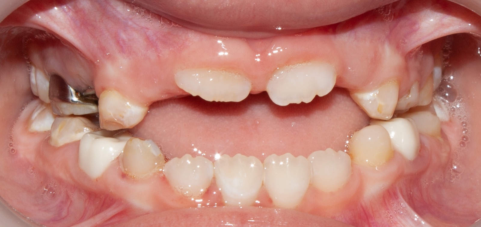 Frontal clinical picture post-restoration.