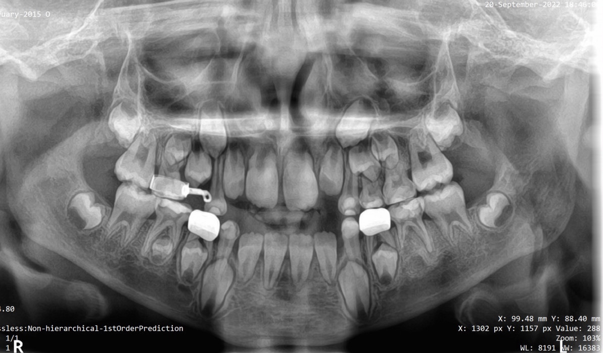 Panoramic xray at the age of 7 year after the completion of the
restorative treatment.