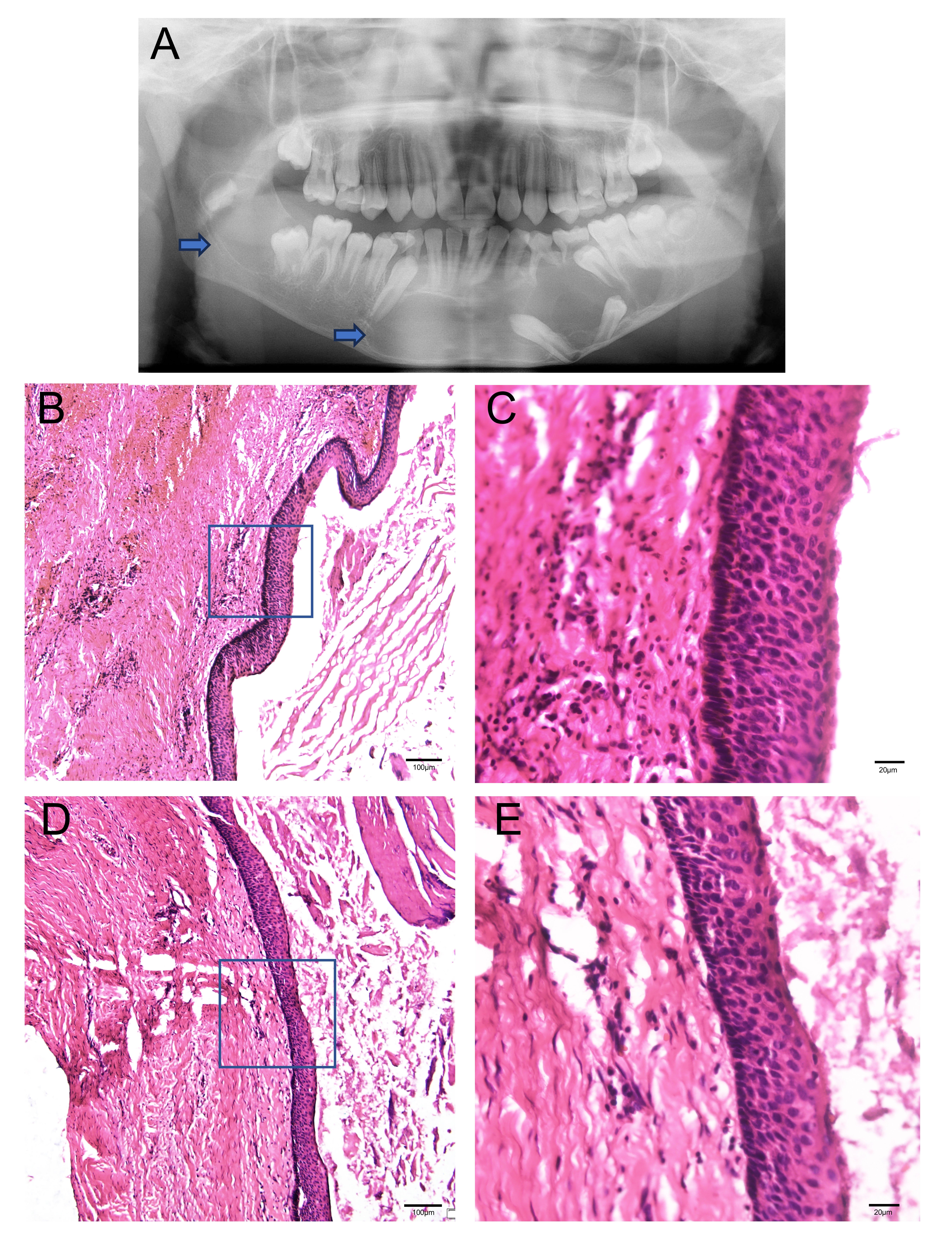 Initial panoramic film and hematoxylin and eosin (HE) stain
images. (A) Two large radiolucent lesions at the first visit (one in the right
mandibular ramus, another one from the tooth 83 to 37). (B) HE staining of the
lesion in the left mandibular bone. (C) Higher magnification HE staining in the
blue box in Fig. 1B. (D) HE staining of the lesion in the right mandibular bone.
(E) Higher magnification HE staining in the blue box in Fig. 1D. Scale bar: 100
μm in Fig. 1B,D; 20 μm in Fig. 1C,E (Blue Arrows in Fig. 1A: the area
of the lesions).