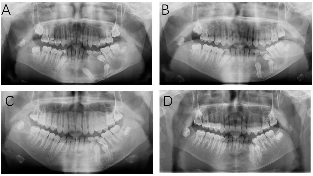 Panoramic radiographs during treatment. (A–D) After the
marsupialization, the panoramic radiograph demonstrated the new bone formation
and the reduction of lesions.