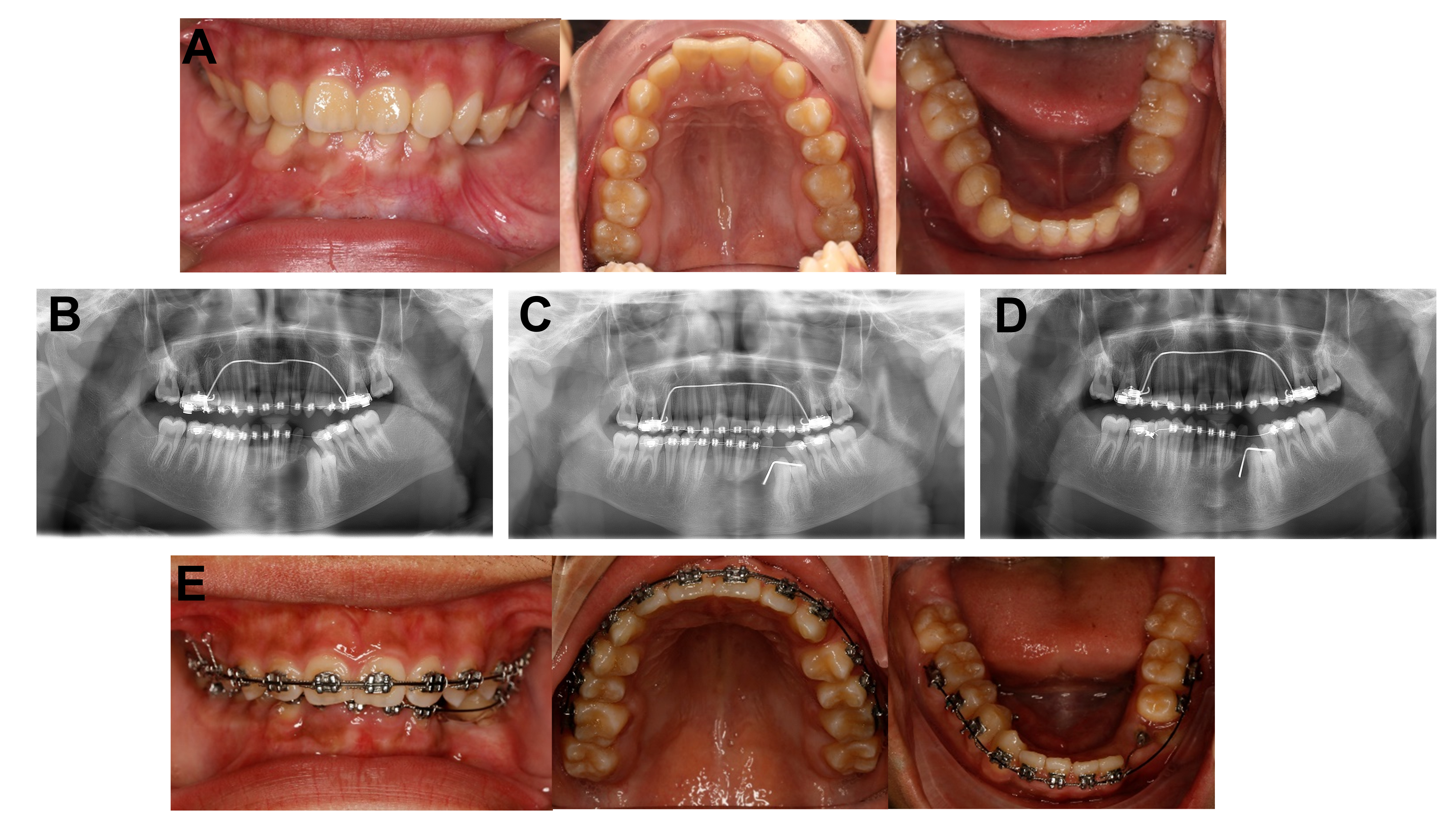 Intraoral photograph and panoramic radiographs during
orthodontic treatment. (A) The photo before starting the orthodontic treatment.
(B) After the enucleation of the lesion at tooth 48, the orthodontic treatment
was used to open space. (C,D) Continuing decompression until the lesion in the
left mandible was small enough to remove entirely by enucleation. (E) The photo
during the orthodontic treatment.