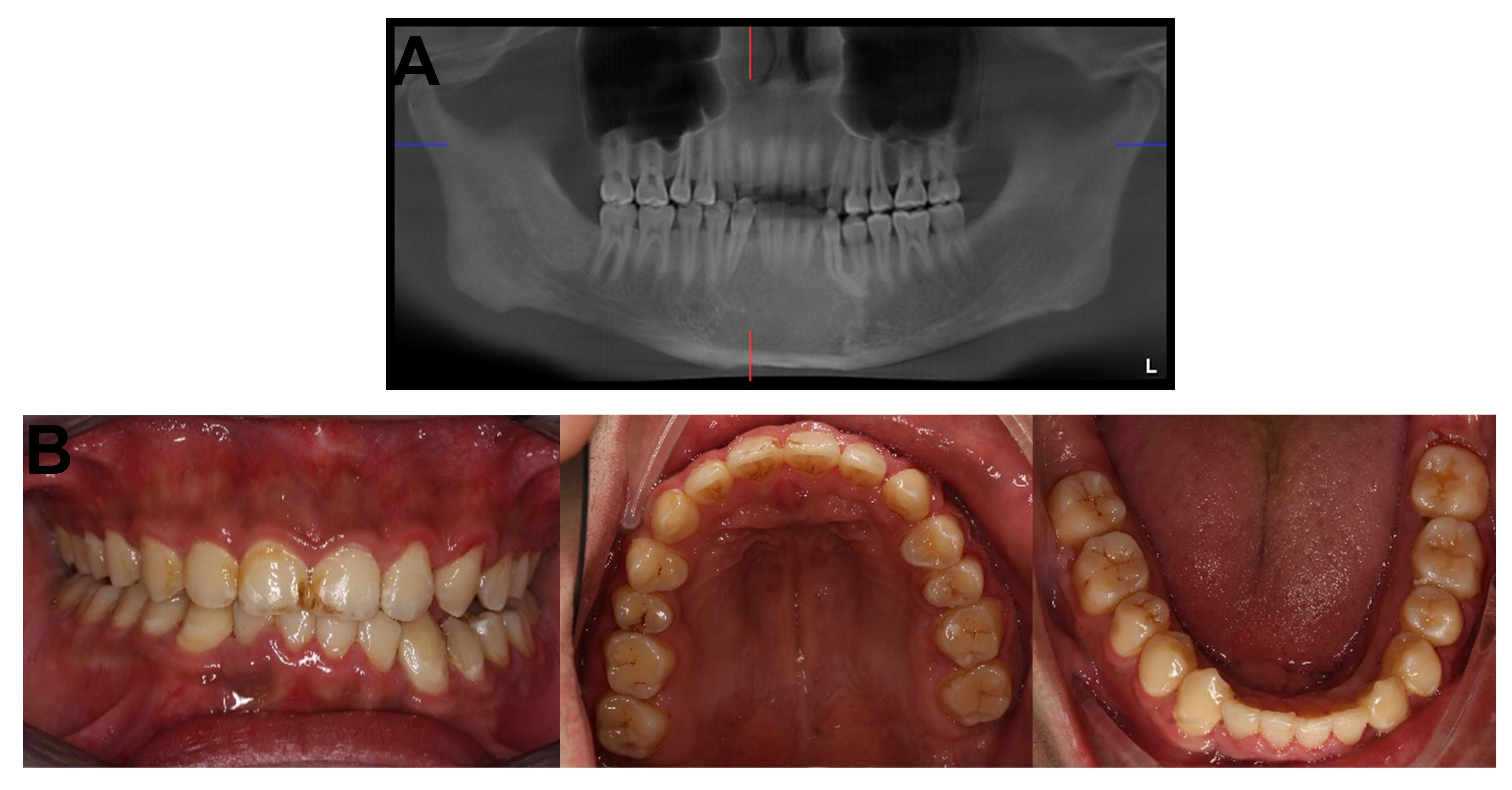 Intraoral photograph and panoramic radiographs after the
treatment. (A) After the orthodontic treatment, the impacted teeth were aligned.
(B) The photo after the comprehensive treatment.