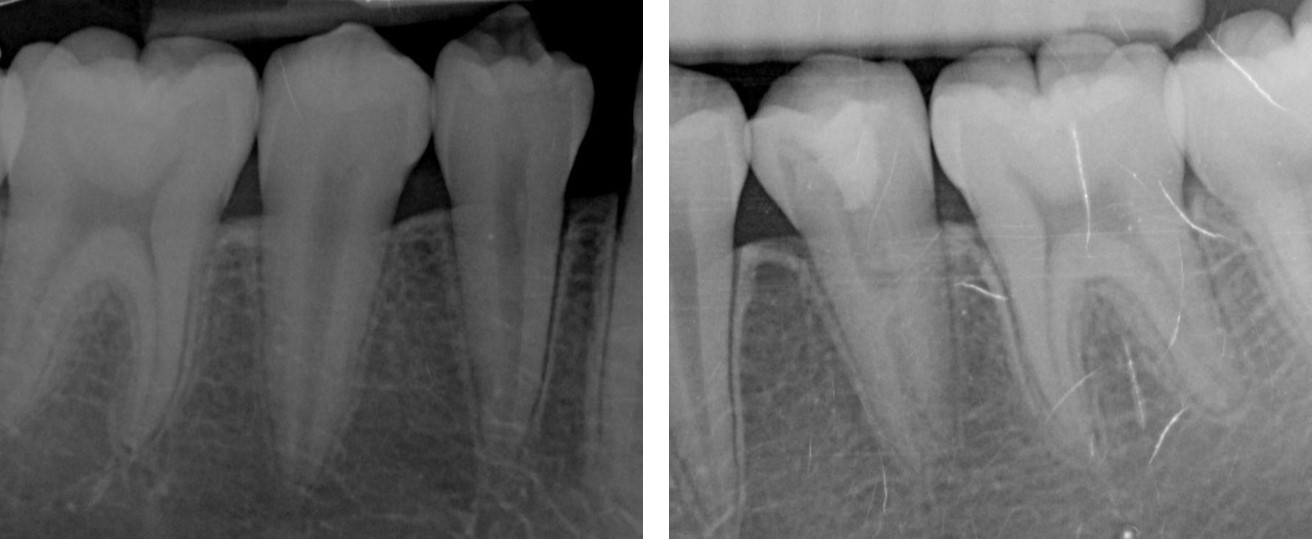 Periapical films of teeth 35 and 45 at the 18-month follow-up
visit. The radiolucent apical lesion of tooth 35 had healed, and there were
increases in root length and root wall thickness observed in both teeth 35 and
45.