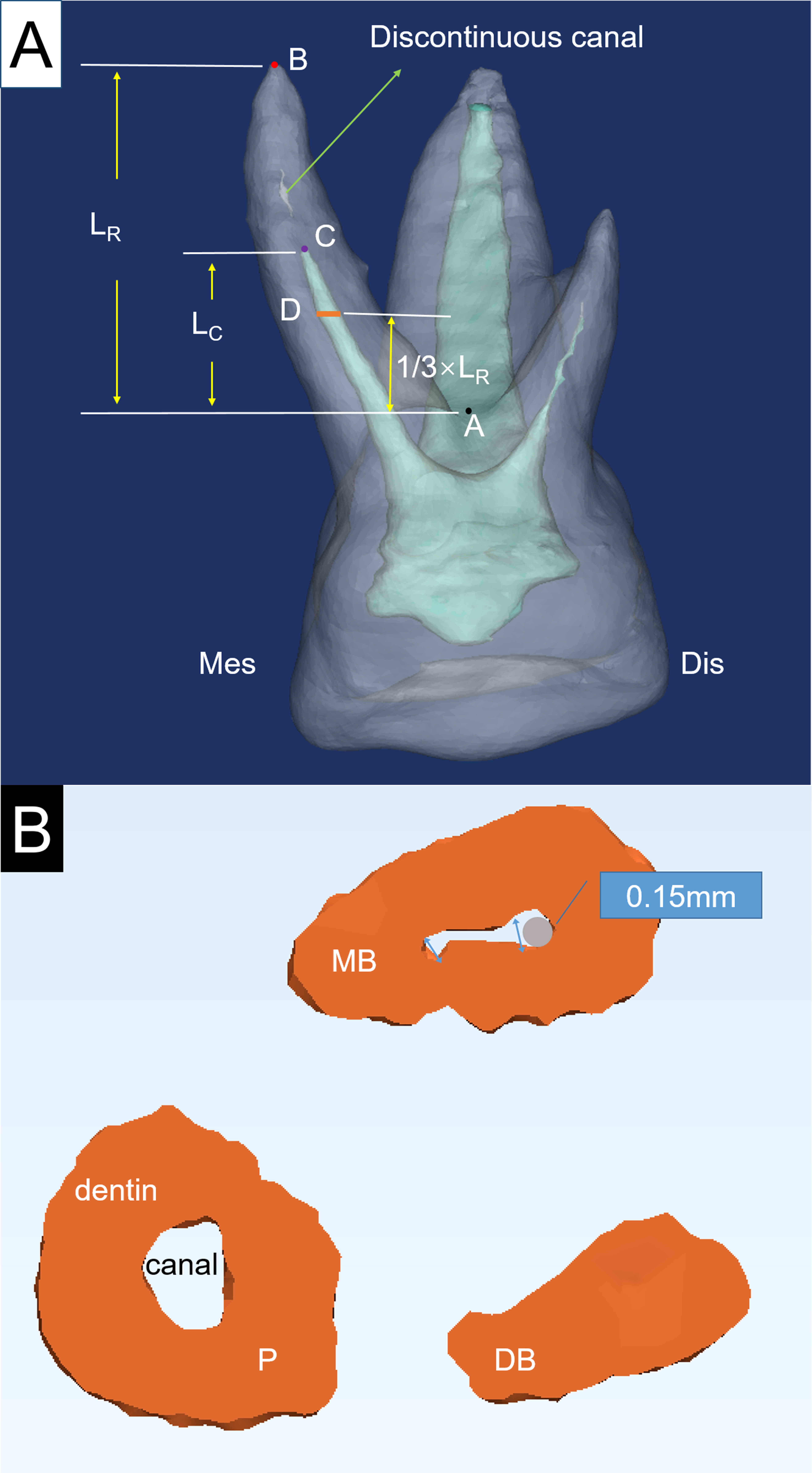 3D reconstruction model of the root and canal for a maxillary
first primary molar. (A) 3D reconstruction model of a maxillary first primary
molar. Points A, B and C; plane D; and LC and LR are indicated. (B)
Root canal segments with a thickness of 0.25 mm starting from plane D toward the
root tip were taken as the region of interest and reconstructed with Mimics 17.0
software. The gray circle represents the tip of a #15 K-file, and the blue
arrows represent the root canal diameter at different positions. A, the lowest
point of the outer surface of the root furcation; B, the anatomical root tip; C,
the point where the canal disappeared toward the root tip for the first time; DB,
distobuccal root; Dis, distal surface; LC, length of the canal measured from
point A to C along the z-axis; LR, length of the root measured from point A
to B along the z-axis; MB, mesiobuccal root; Mes, mesial surface; P, palatal
root; Plane D, the plane 1/3 × LR from point A toward the root tip along the
z-axis, which is perpendicular to the z-axis.