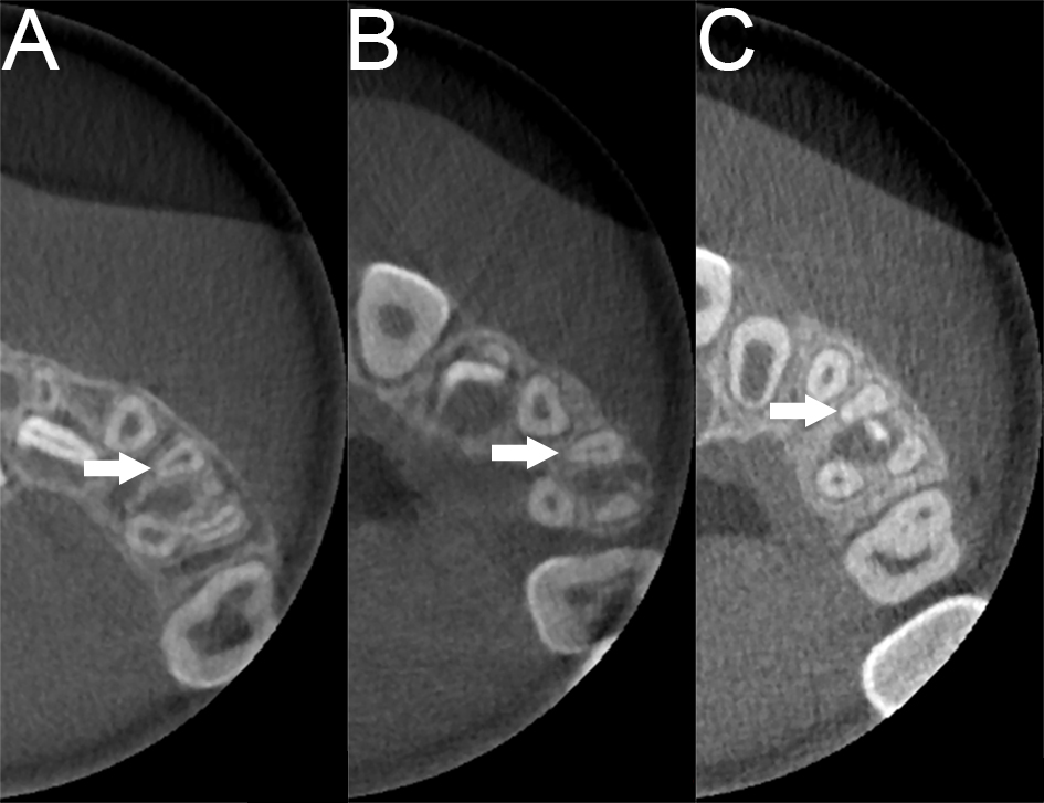 Decrease in the canal diameter of the maxillary first primary
molar with age. (A) The MB canal of a 3-year-old child. (B) MB canal of a
6-year-old child. (C) MB canal of an 8-year-old child. From A to C, the lumen of
the MB canal decreases.