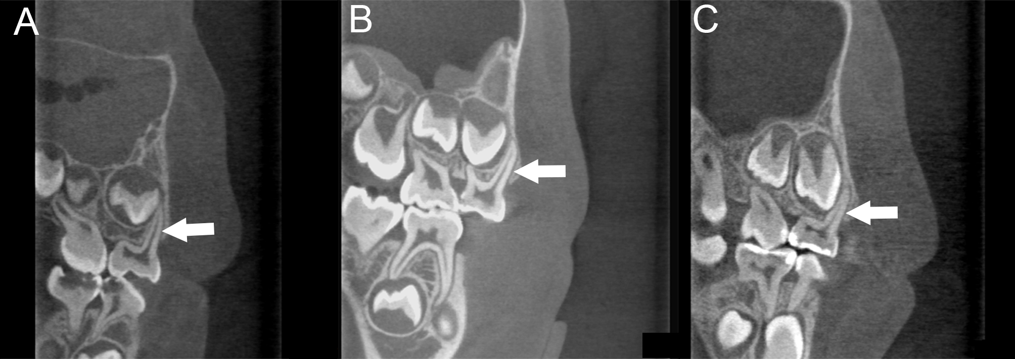 Decrease in the canal length of the maxillary first primary molar
relative to the root length (LC/LR). (A) MB canal of a 4-year-old
child. (B) MB canal of a 6-year-old child. (C) MB canal of an 8-year-old child.