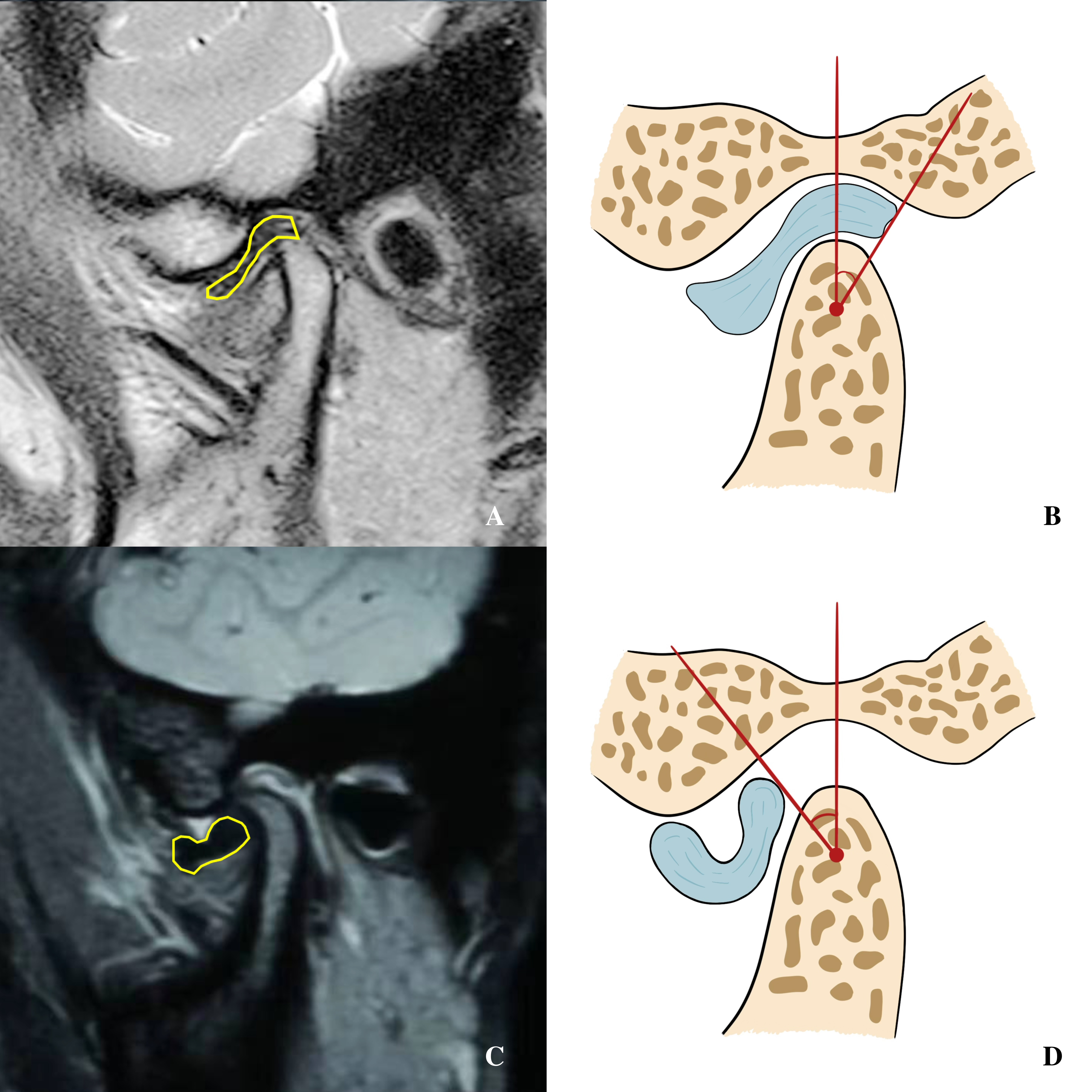 The angle diagnostic method of DD. The Chinese Stomatological 
Association provided guidelines in 2020 which are as follows: when the mouth is 
closed, the top of the condyle and the center of the condyle is used as line 1; 
the posterior edge of the posterior band and the center of the condyle is used as 
the line 2. When the angle between these two lines is larger than 15°, 
DD can be defined. (A,B) MRI of healthy joints. (C,D) MRI of DD joints.