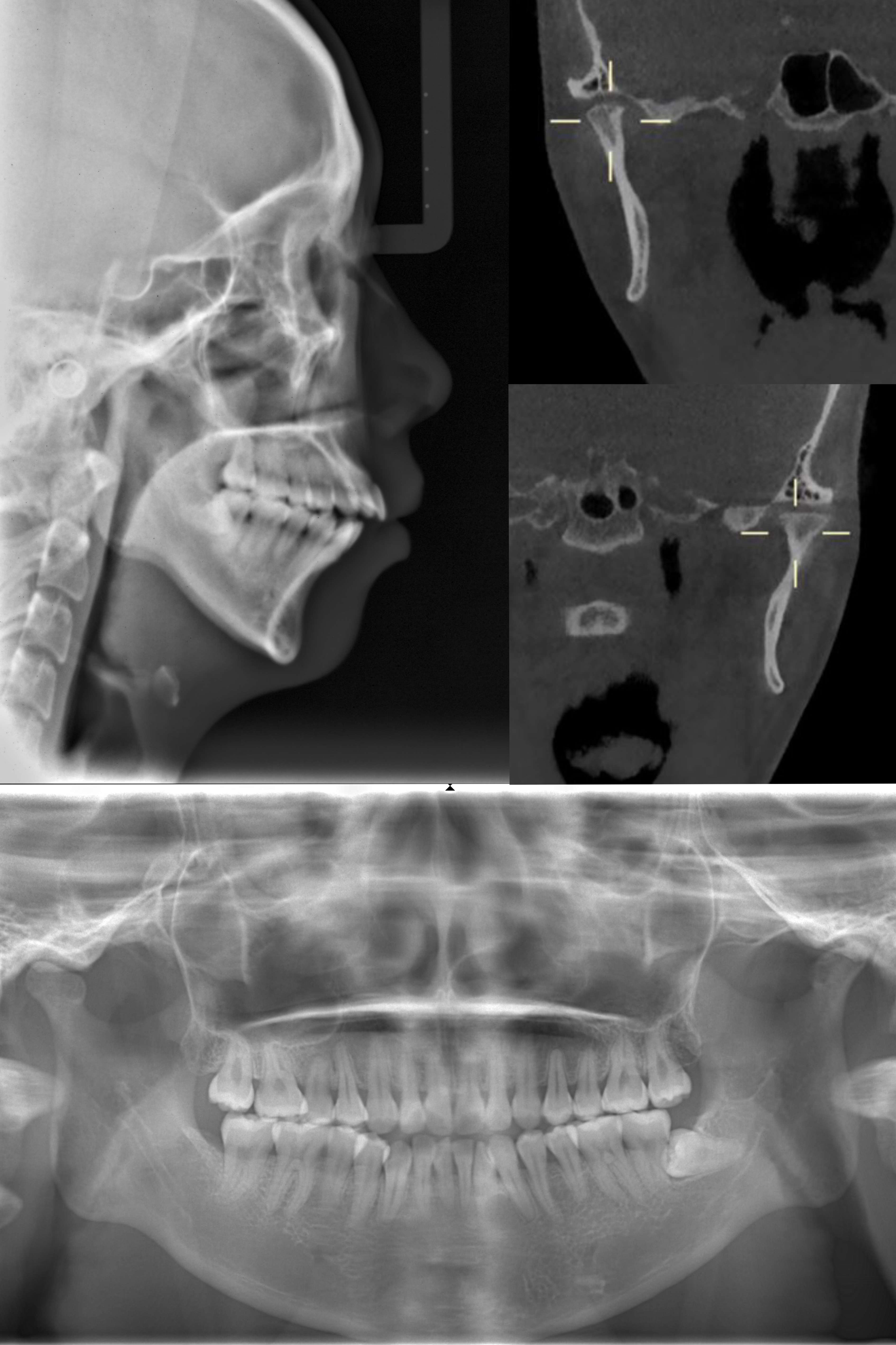 A 23-year-old woman who suffered from DD during adolescence demonstrated a skeletal Class II malocclusion with an anterior open bite.