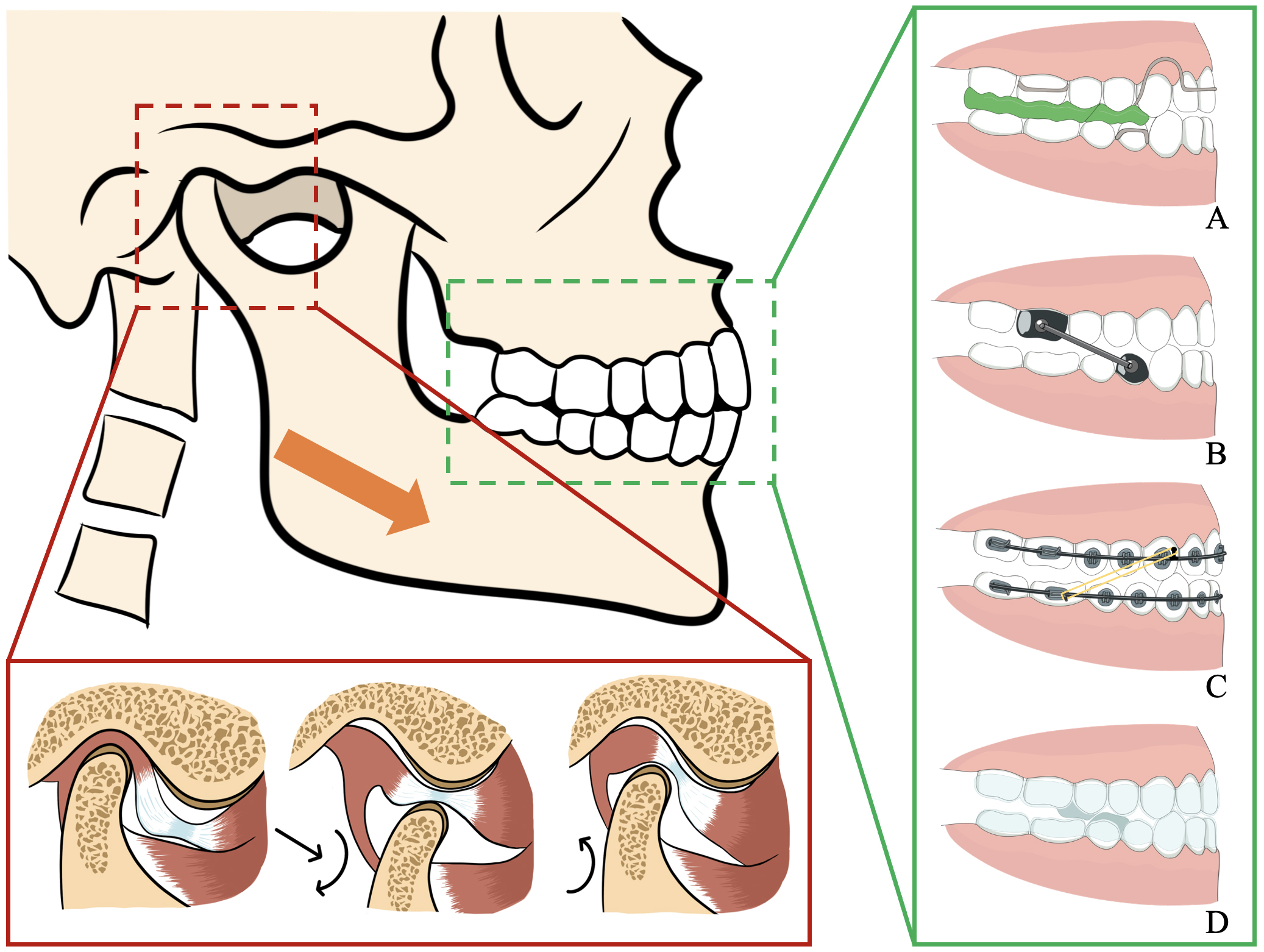 The principle of Orthodontic therapies on DD. Orthodontic 
methods can lead to mandibular advancement, thus causing the rotation and sliding 
of the condyle to catch the TMJ disc. (A) Twin-block maintains the mandible 
position by splints on the premolars and molars. (B) Herbst using a rigid tube 
that rests between the upper and lower teeth. (C) Fixed appliance promotes 
mandibular advancement by elastic traction and removing resistance to mandibular 
movement through dentition alignment. (D) Clear aligner can also work with 
splints.