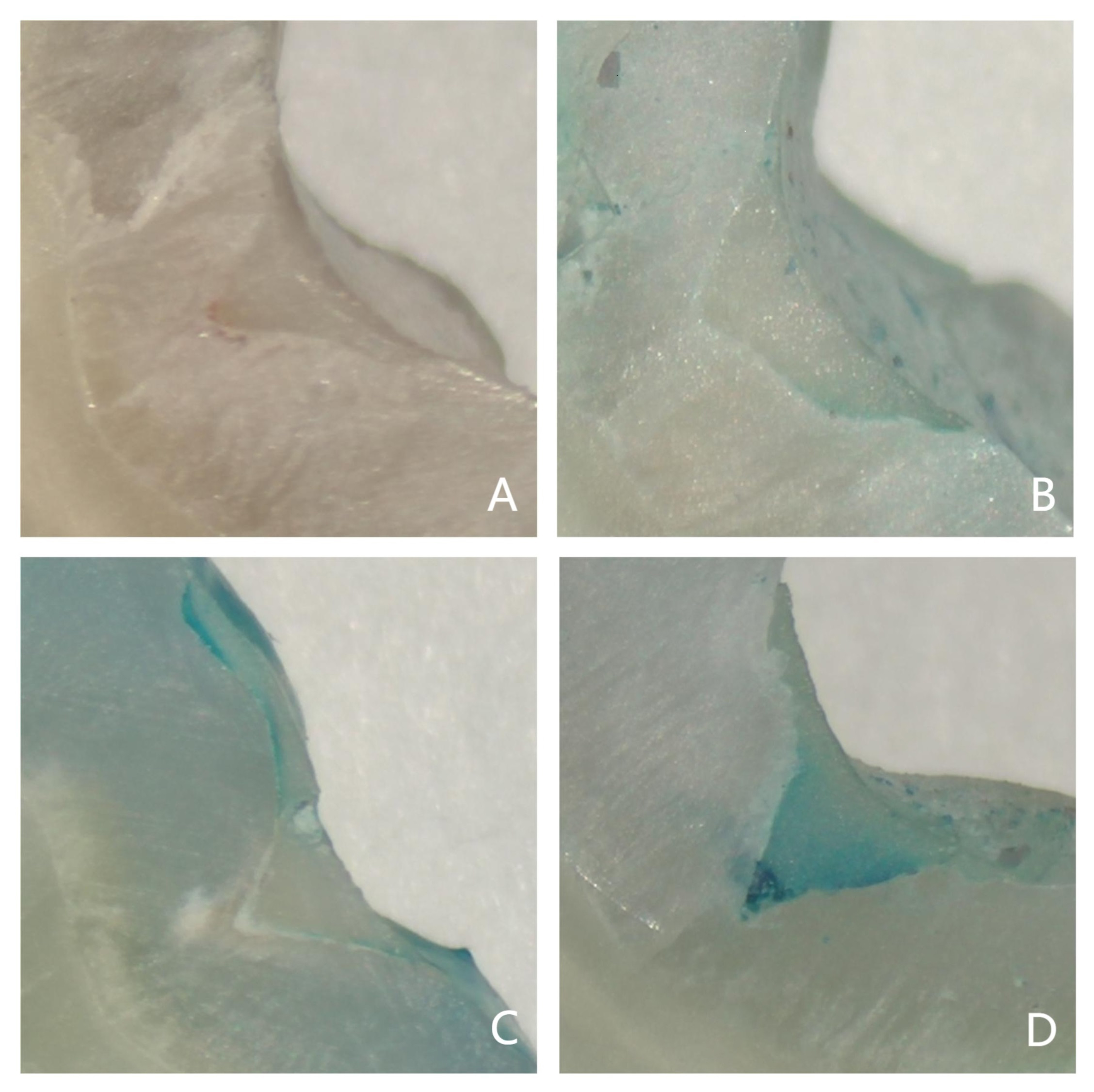 Dye penetration method for microleakage. (A) Level 0, no 
staining. (B) Level 1, staining limited to less than 1/2 of the fissure sealant 
margin. (C) Level 2, staining extending beyond 1/2 of the fissure sealant margin. 
(D) Level 3, staining penetrating to the bottom of the fissure.