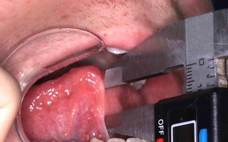 Measurement of Ankyloglossia.