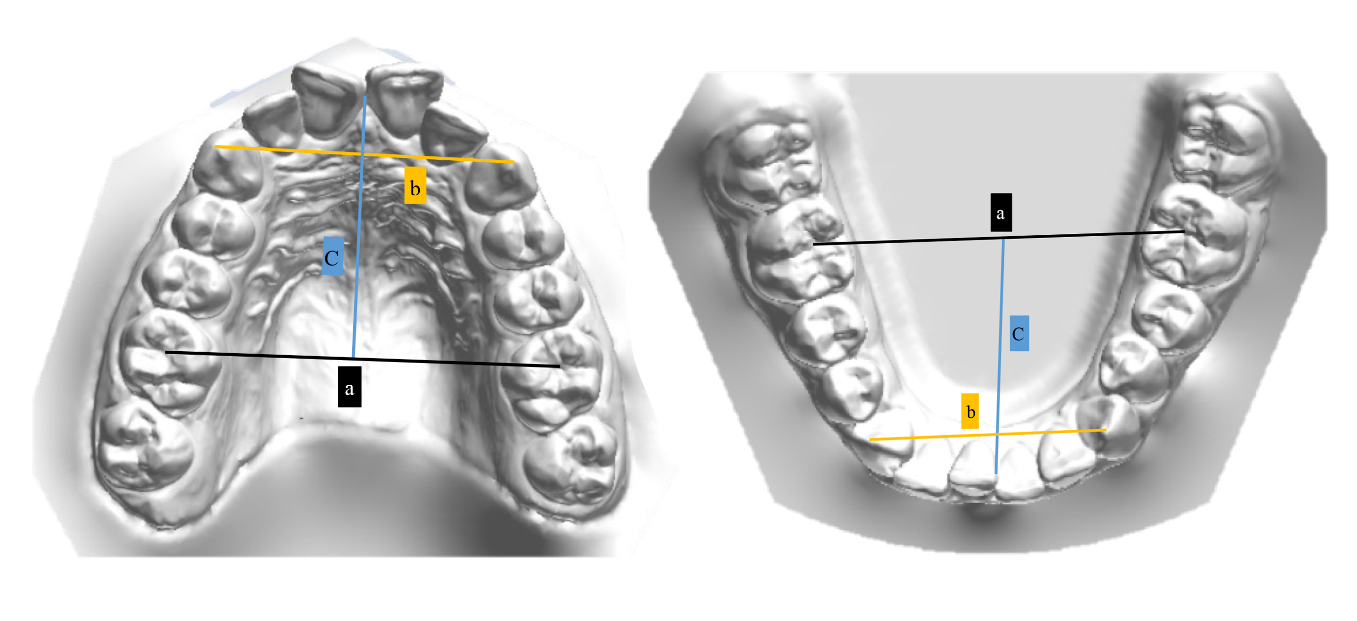 Arch measurements on dental casts. a: Inter-molar arch width
(mm)—measured between central fossae of first molars, b: Inter-canine arch
width (mm)—measured between canine cusp tips, c: Arch length (mm)—measured
between the buccal contact point of central incisors to the line indicating
inter-molar width.