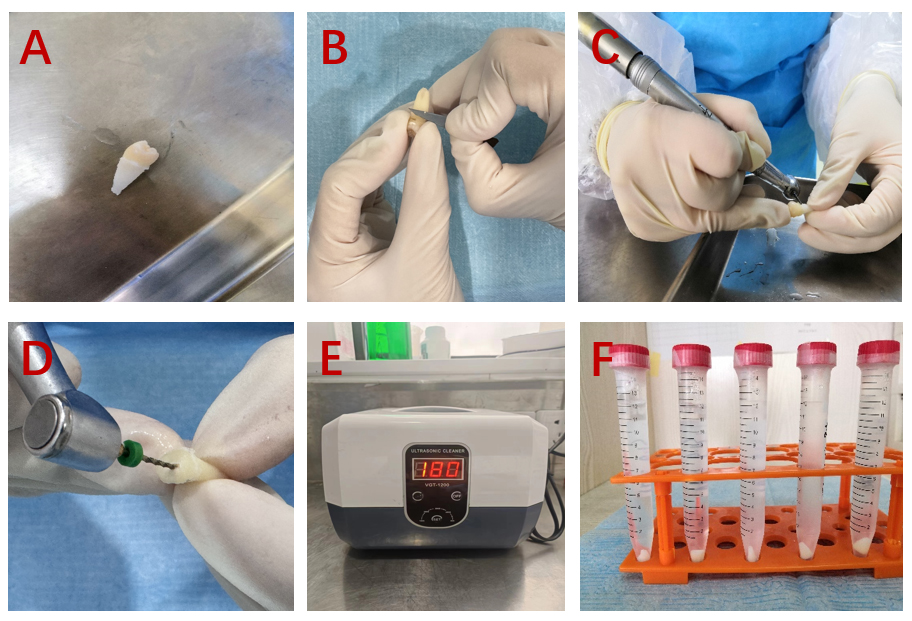 Preparation of dental cavities. (A) Extracted premolars; (B)
Residual periodontal tissue on the root surface of in vitro teeth were
scraped with a surgical blade; (C,D) Process for preparing dental cavities; (E)
Ultrasonic scouring; (F) Sterile triple antibiotic solution containing dental
cavities.
