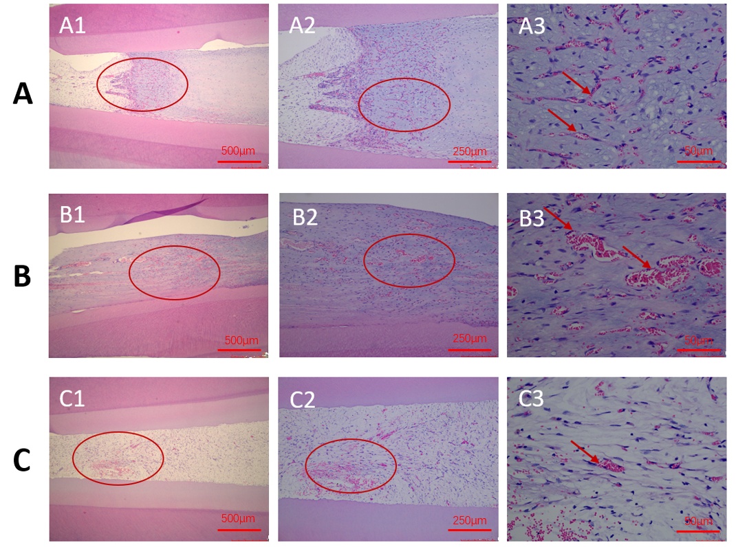Histological analysis. Fig. 3A shows the deciduous pulp group
(Group A). (A1) Detection of fibrous connective tissue and pulp tissue in the
root canal (×20); (A2) Enlargement of the circled area in Fig. 3A1
(×40); (A3) Enlargement of the circled area in Fig. 3A2 displays
vascular endothelial cells form obvious vascular cavities, most of which are
small vascular cavities, with red arrows indicating neovascularization lumens
(×200). Fig. 3B shows the deciduous pulp/Matrigel group (Group B). (B1)
Root canal contains many fibrous connective tissue and dental pulp tissue
(×20); (B2) Enlargement of the circled area in Fig. 3B1 (×40);
(B3) Enlargement of the circled area in Fig. 3B2 displays vascular endothelial
cells form an obvious vascular cavity, most of which are small vascular cavities,
with red arrows indicating neovascular cavity (×200). Fig. 3C shows the
negative control group (Group C). (C1) A small amount of fibrous connective
tissue is present in the root canal and blood vessels are visible (×20);
(C2) Enlargement of the circled area in Fig. 3C1 (×40); (C3) Enlargement
of the circled area in Fig. 3C2, with the red arrow indicating vascular cavity
(×200).