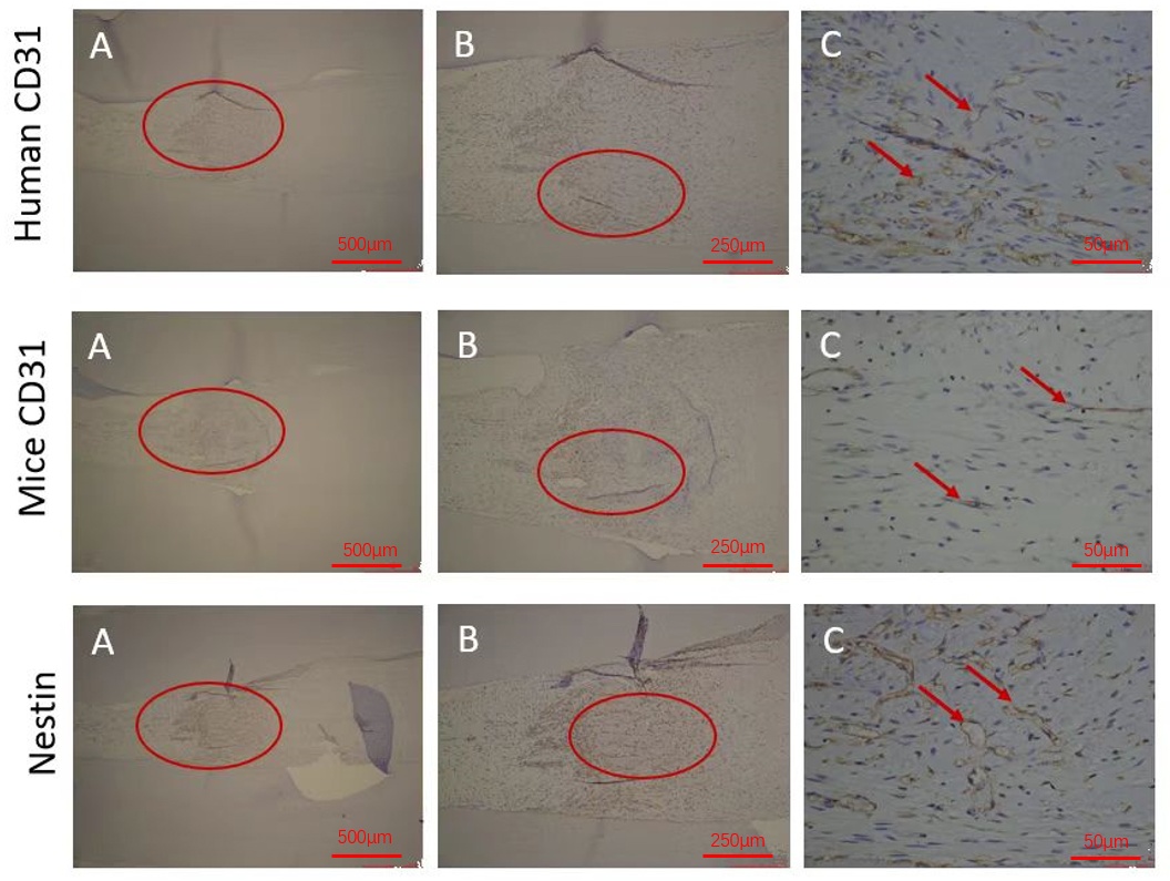 Immunohistochemical staining of the deciduous pulp group (Group
A). The first row of images shows Human CD31 localization. (A) Canal tissue rich
in blood vessels (×20); (B) enlargement of the circled area in panel A
(×40); (C) red arrows indicate blood vessels. The second row of images
shows Mice CD31 localization. (A) Canal tissue is rich in blood vessels
(×20); (B) enlargement of the circled area in panel A (×40);
(C) red arrows indicate blood vessels. The third row of images shows localization
of anti-Nestin antibody binding to nerve fibers. (A) Canal tissue is rich in
nerve fibers (×20); (B) enlargement of the circled area in panel A
(×40); (C) red arrows indicate nerve fibers.