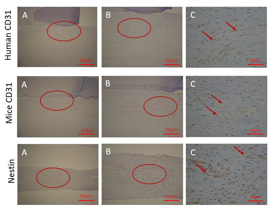 Immunohistochemical staining of the deciduous pulp/Matrigel
group (Group B). The first row of images shows Human CD31 localization. (A) Canal
tissue rich in blood vessels (×20); (B) enlargement of the circled area
in panel A (×40); (C) red arrows indicate blood vessels. The second row
of images shows Mice CD31 localization. (A) Canal tissue is rich in blood vessels
(×20); (B) enlargement of the circled area in panel A (×40);
(C) red arrows indicate blood vessels. The third row of images shows localization
of anti-Nestin antibody binding to nerve fibers. (A) Canal tissue is rich in
nerve fibers (×20); (B) enlargement of the circled area in panel A
(×40); (C) red arrows indicate nerve fibers.