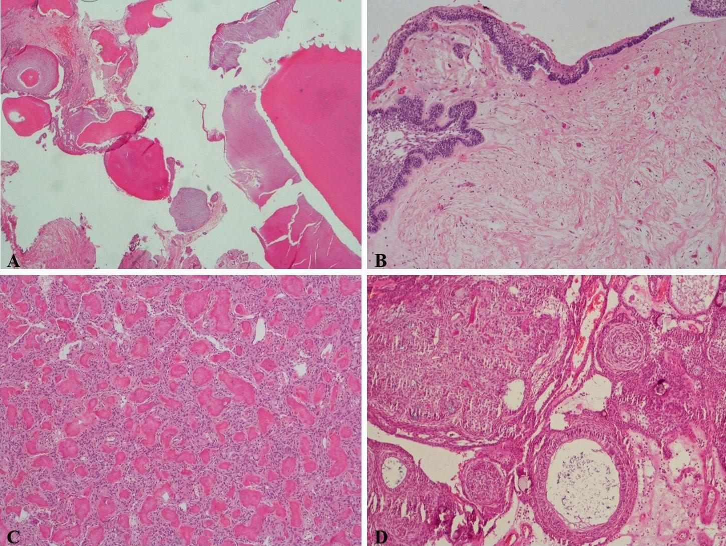 Histopathologic examination of odontogenic tumors. (A) Odontoma 
(H&amp;E ×100): Mixed odontogenic tumor showing dentin, enamel, and 
pulp-like tissues. (B) Ameloblastoma, unicystic type (H&amp;E ×100): A 
single cystic lesion with ameloblast-like cells lining the cyst wall. (C) 
Cemento-ossifying fibroma (H&amp;E ×100): Fibrous stroma containing 
trabeculae of bone and cementum-like material. (D) Adenomatoid odontogenic tumor 
(H&amp;E ×100): Lesion composed of duct-like structures and calcified 
material surrounded by spindle-shaped epithelial cells.