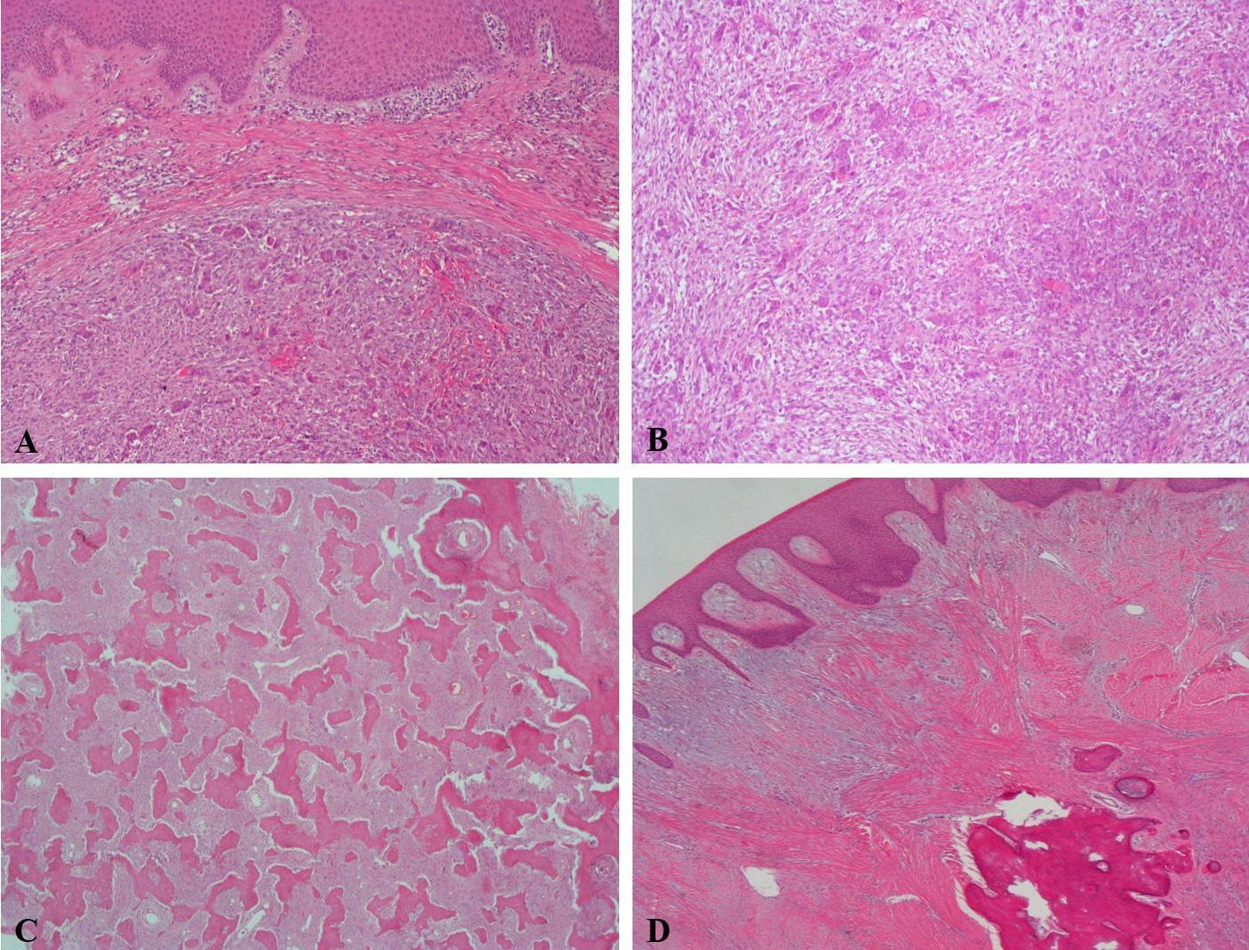 Histopathologic examination of giant cell and fibroosseous 
lesions. (A) Peripheral giant cell granuloma (H&amp;E ×100): Proliferation 
of multinucleated giant cells within a fibrous stroma. (B) Central giant cell 
granuloma (H&amp;E ×100): Intraosseous lesion with multinucleated giant 
cells and fibrovascular stroma. (C) Fibrous dysplasia (H&amp;E ×40): 
Irregularly shaped woven bone trabeculae within a fibrous stroma. (D) Peripheral 
ossifying fibroma (H&amp;E ×40): Fibrous tissue proliferation with focal 
calcifications and ossification.