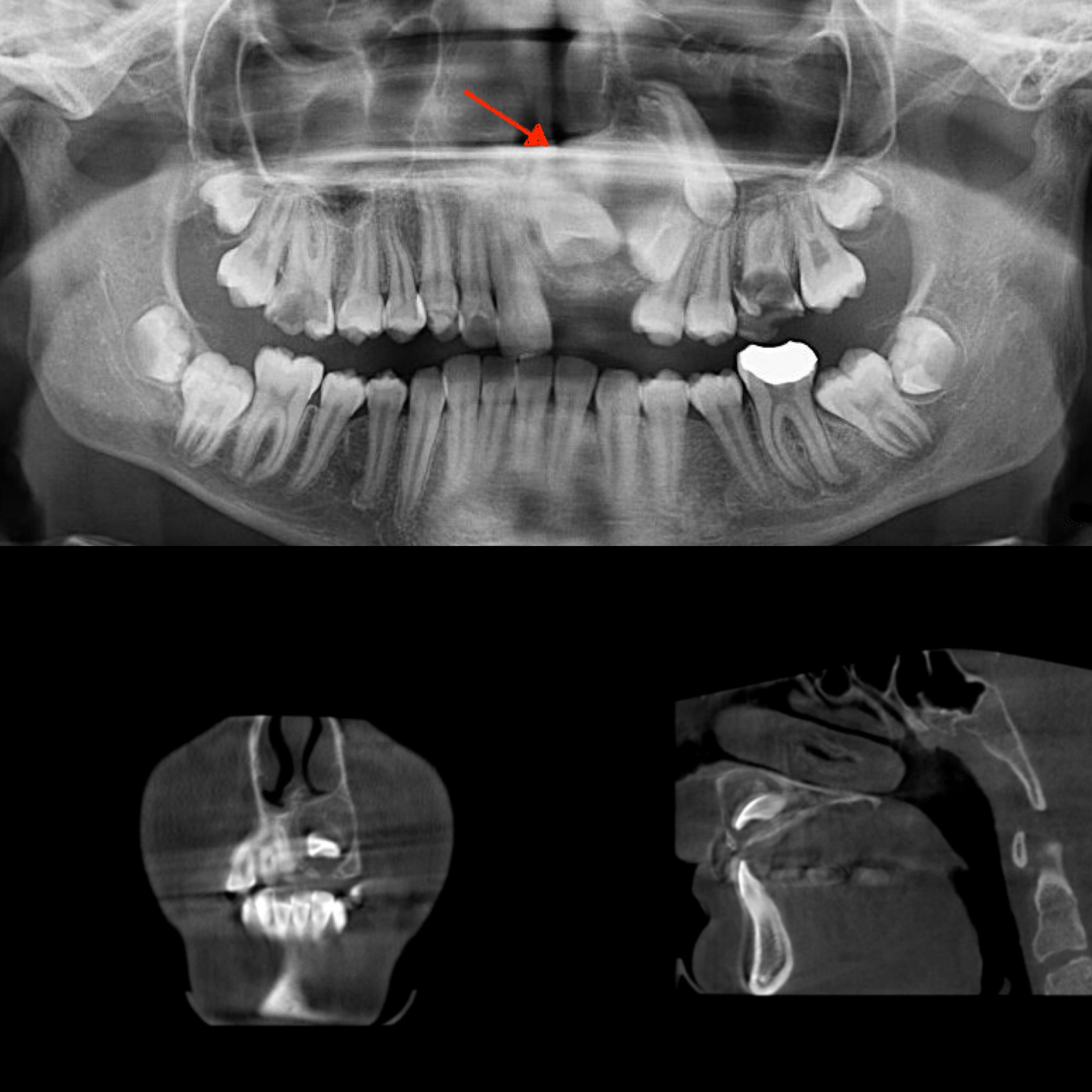 Panoramic and CBCT showing an adenomatoid odontogenic tumor on 
the left side in the anterior region of the maxilla. The lesion is indicated by 
a red arrow.