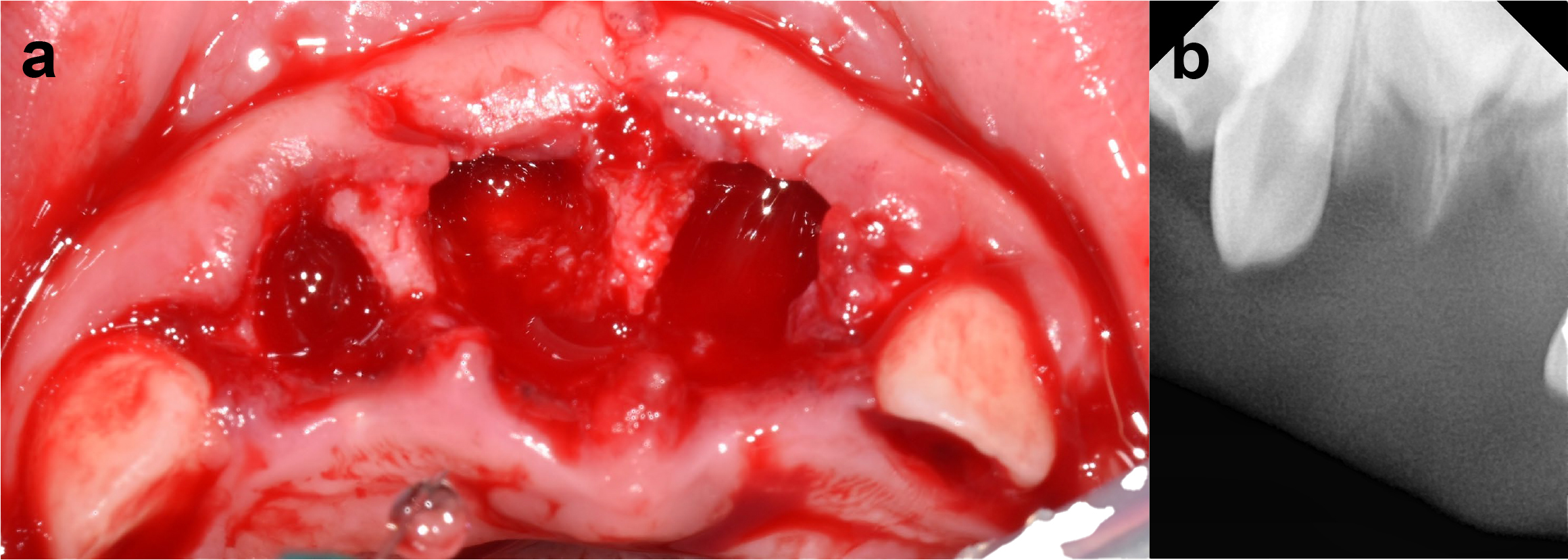 At initial visit. (a) Clinical photo. Displays the maxillary 
region post-trauma, highlighting empty alveolar sockets with blood clots and 
surrounding soft tissue lacerations where the primary incisors (#51, #52 and 
#61) were avulsed. (b) Periapical radiograph. Shows total avulsion of the 
primary incisors. The radiograph does not show the periapex or the permanent 
tooth buds; focus is solely on the affected area.