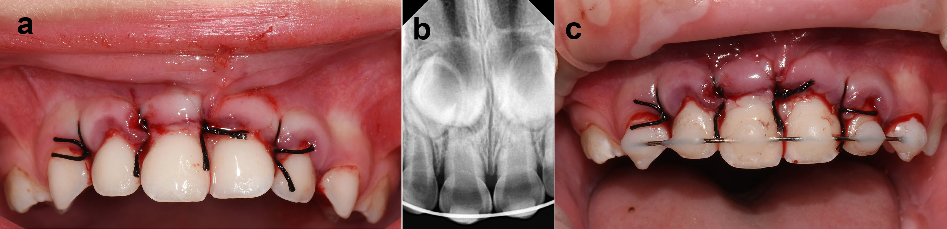 Replantation procedure. (a) Replantation of the primary teeth. 
(b) Periapical radiograph. The radiograph confirmed that the teeth were placed in 
the proper position in the alveolar sockets. (c) Tooth splinting.