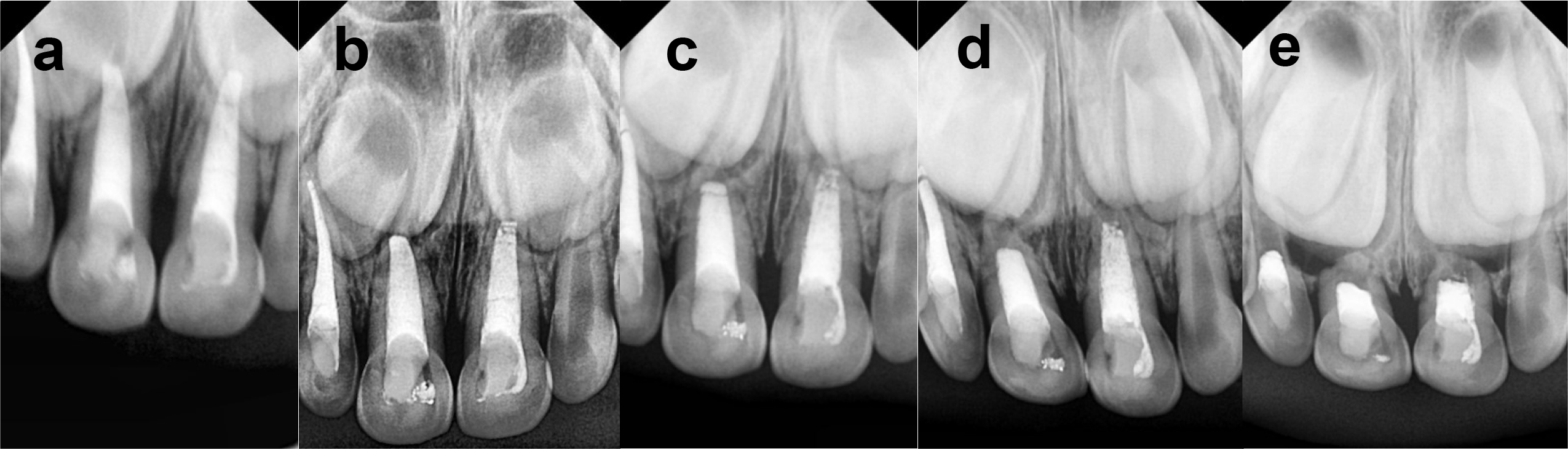 Follow-up radiography. (a) 6-month follow-up periapical 
radiograph. (b) 1-year follow-up periapical radiograph. (c) 2-year follow-up 
periapical radiograph. (d) 3-year follow-up periapical radiograph. (e) 3.5-year 
follow-up periapical radiograph.