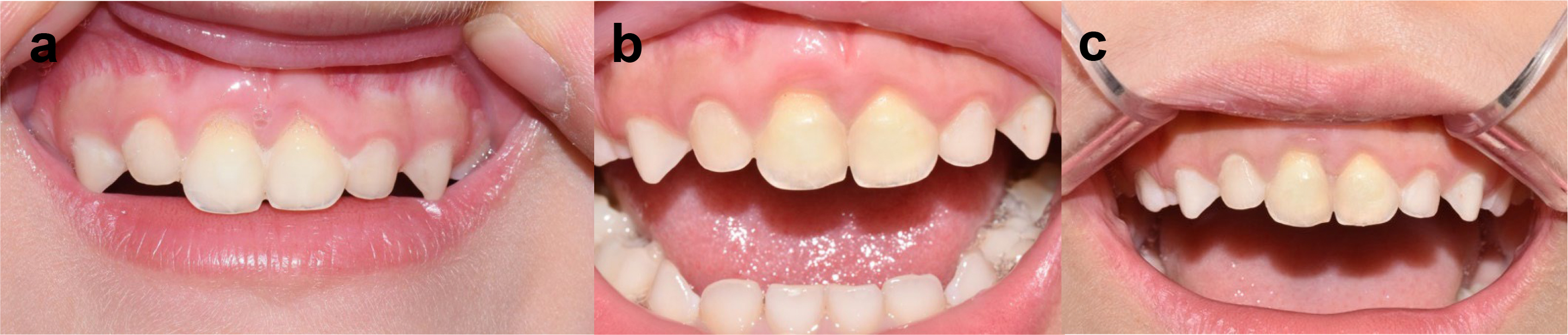 Follow-up images. (a) 6-month follow-up periapical photograph. 
(b) 1-year follow-up periapical photograph. (c) 3-year follow-up periapical 
photograph.