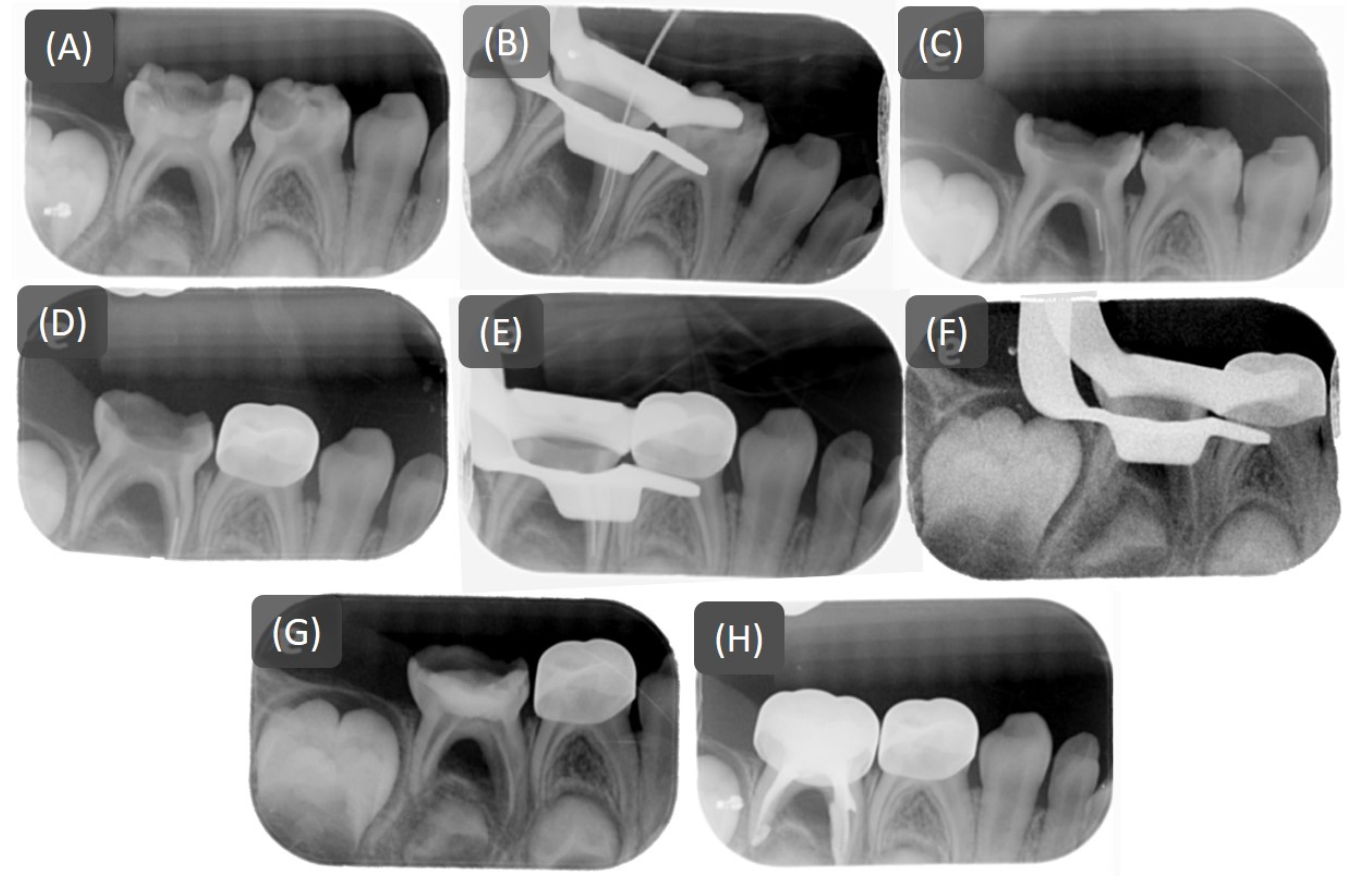 Preoperative, intraoperative, and postoperative periapical
films. (A) Preoperative x-ray of tooth 85, showed deep caries involving the pulp.
(B) Initial discovery: The initial occurrence of a separated file was identified
by the pediatric dentist during the working length assessment with a periapical
film, revealing radiopaque material in the coronal area of the canal. The
retained K-file measured approximately 4 mm in length. (C) Location confirmation:
The next periapical confirmed the presence of a separated instrument in the
coronal area. (D) Endodontist’s assessment: Upon arrival of the endodontist, an
X-ray confirmed that the instrument had fallen into the apical area. (E) File
position change: With rubber dam isolation, initiate coronal pre-flaring with a
Gates Glidden drill aimed at directly exposing the separated instrument. A #15
K-file was used with help from an endoscope to determine whether the instrument
was loose after enlarging the coronal area. Upon verifying the file looseness,
17% EDTA was irrigated into the canal and activated by ultrasonic (Ultra-X,
Eighteeth, Jiangsu, China). The separated instrument was clearly visible in the
coronal area of the canal. (F) Removal confirm: Once the separated instrument was
loosened, an H-file was used with the braiding technique, followed by a DG 16
explorer to remove it. Periapical film confirmed the successful extraction of the
separated instrument. (G) Final step of removal: Periapical film taken after
sealing the tooth coronally with Caviton (GC, Aichi, Japan) confirmed the
procedure’s completion. (H) Postoperative x-ray of tooth 85 area, showed a
pulpectomy with Vitapex and the fabrication of a stainless steel crown for tooth
85.
