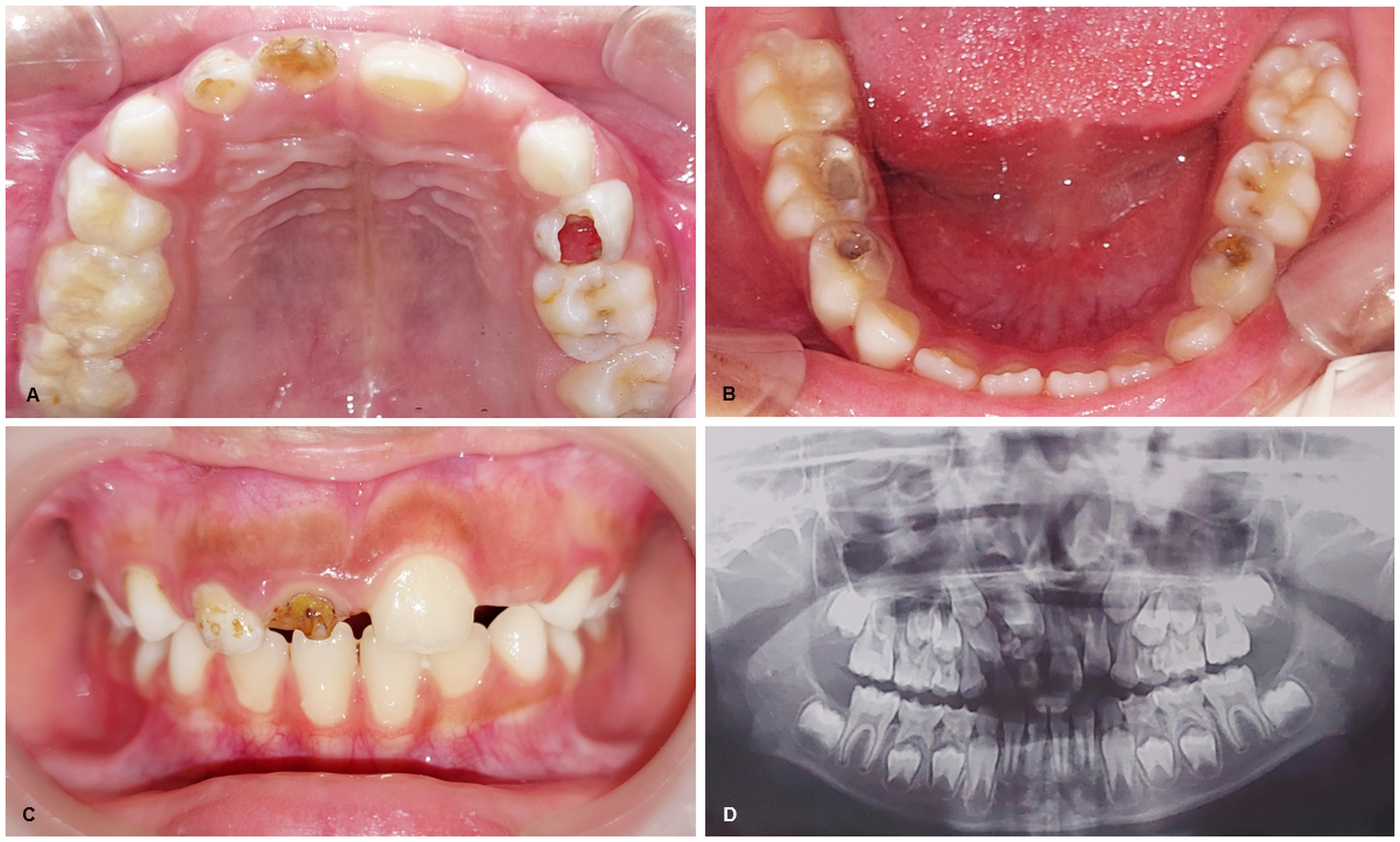 Intra oral and radiographic
examination. (A–C) Carious lesions in teeth 16, 55, 52, 51, 64, 75, 74 and 84,
retention of teeth 52 and 51. (D) Panoramic figure showed multiple radiopaque
lesions with well-defined border surrounded by radiolucent area on the anterior
right upper jaw.