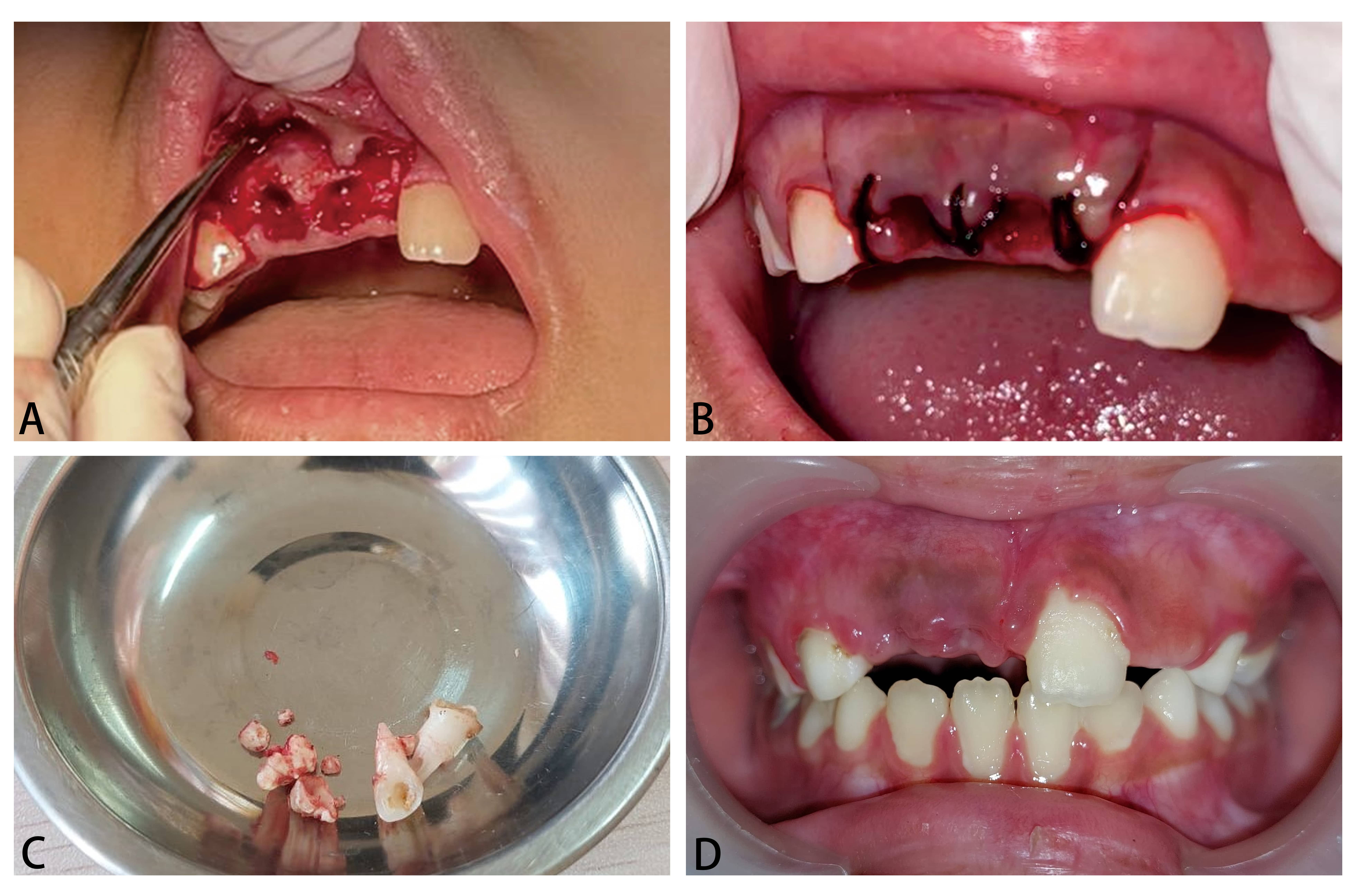 The odontoma removal and
post odontoma removal control. (A,B) Surgical odontoma removal processing. (C)
The specimen collected from the operation site showing numerous miniature
tooth-like structures representing compound type of odontoma. (D) The intra oral
examination on the 7th day follow-up post-odontoma removal.