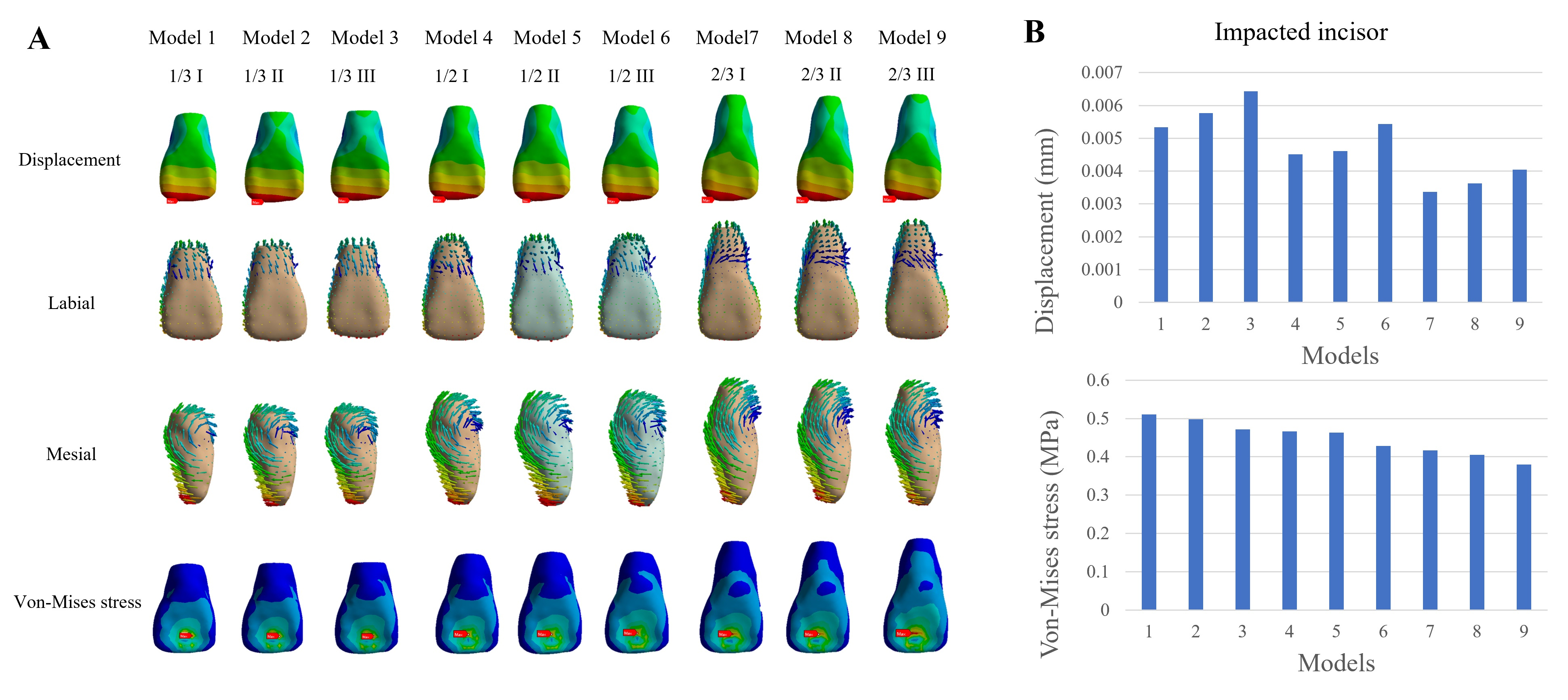 Initial displacement and von Mises stress cloud maps (A) and 
values (B) of inverted impacted central incisor of 9 three-dimensional finite 
element models. Blue to red reflects lower to higher displacement and stress.