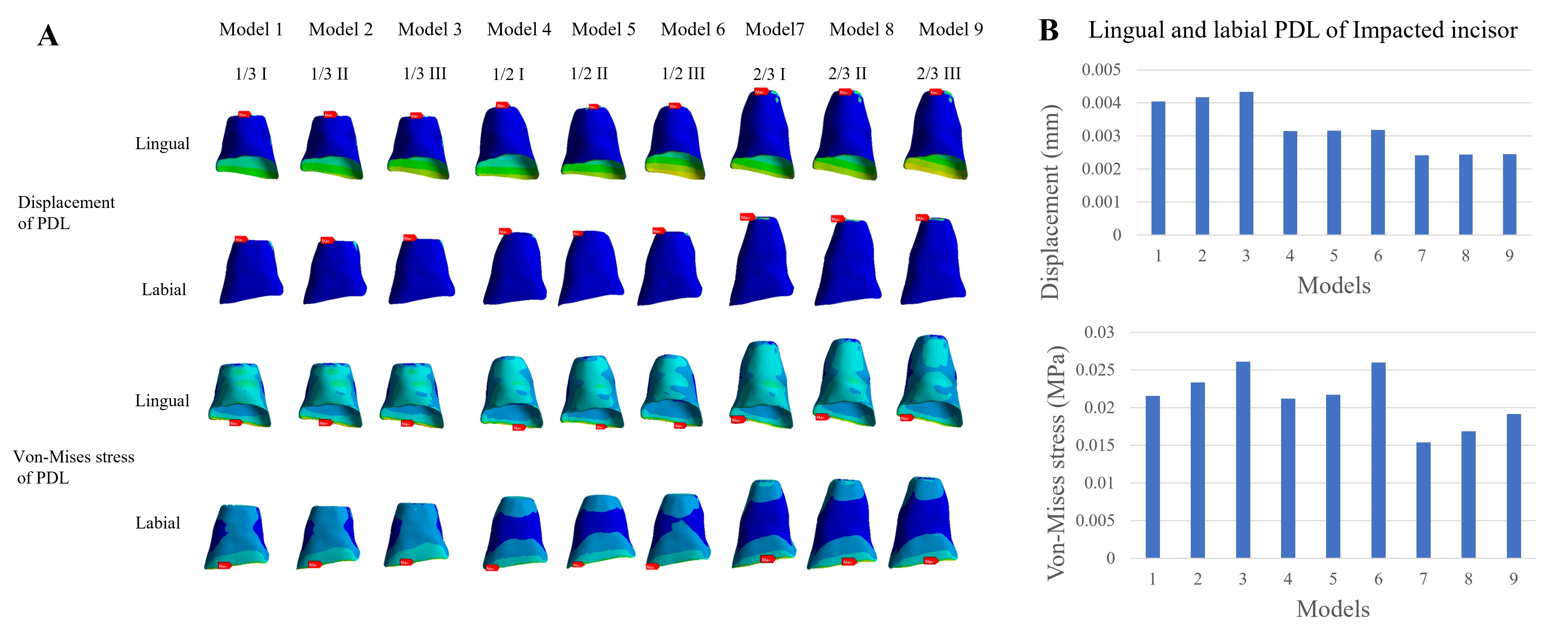 Initial displacement and von Mises stress cloud maps (A) and 
values (B) in the lingual and labial PDL of inverted impacted central incisor of 
9 three-dimensional finite element models. PDL: periodontal ligament.