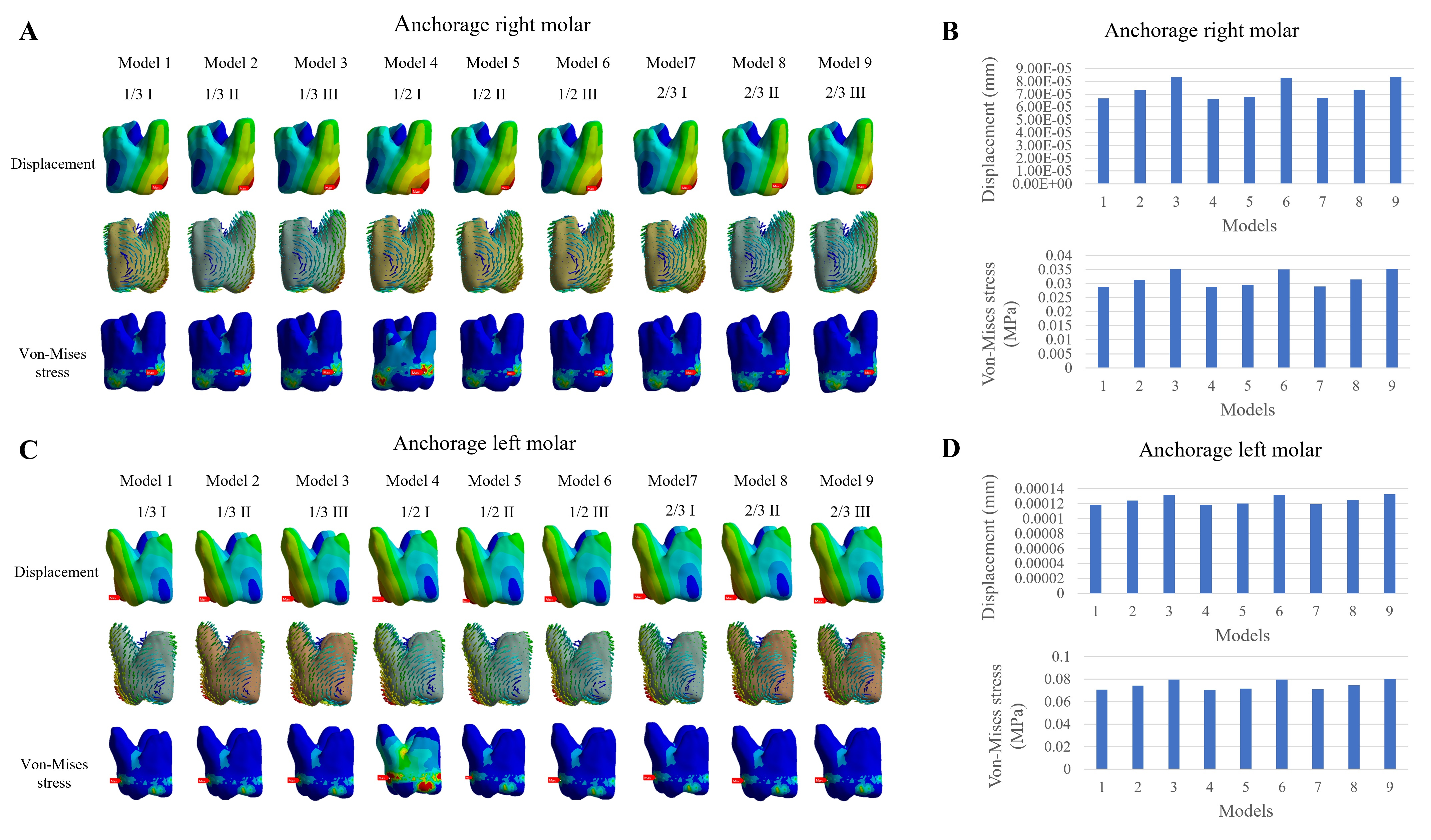 Initial displacement and von Mises stress cloud maps (A,C) and 
values (B,D) of right and left anchorage molars of 9 three-dimensional finite 
element models.