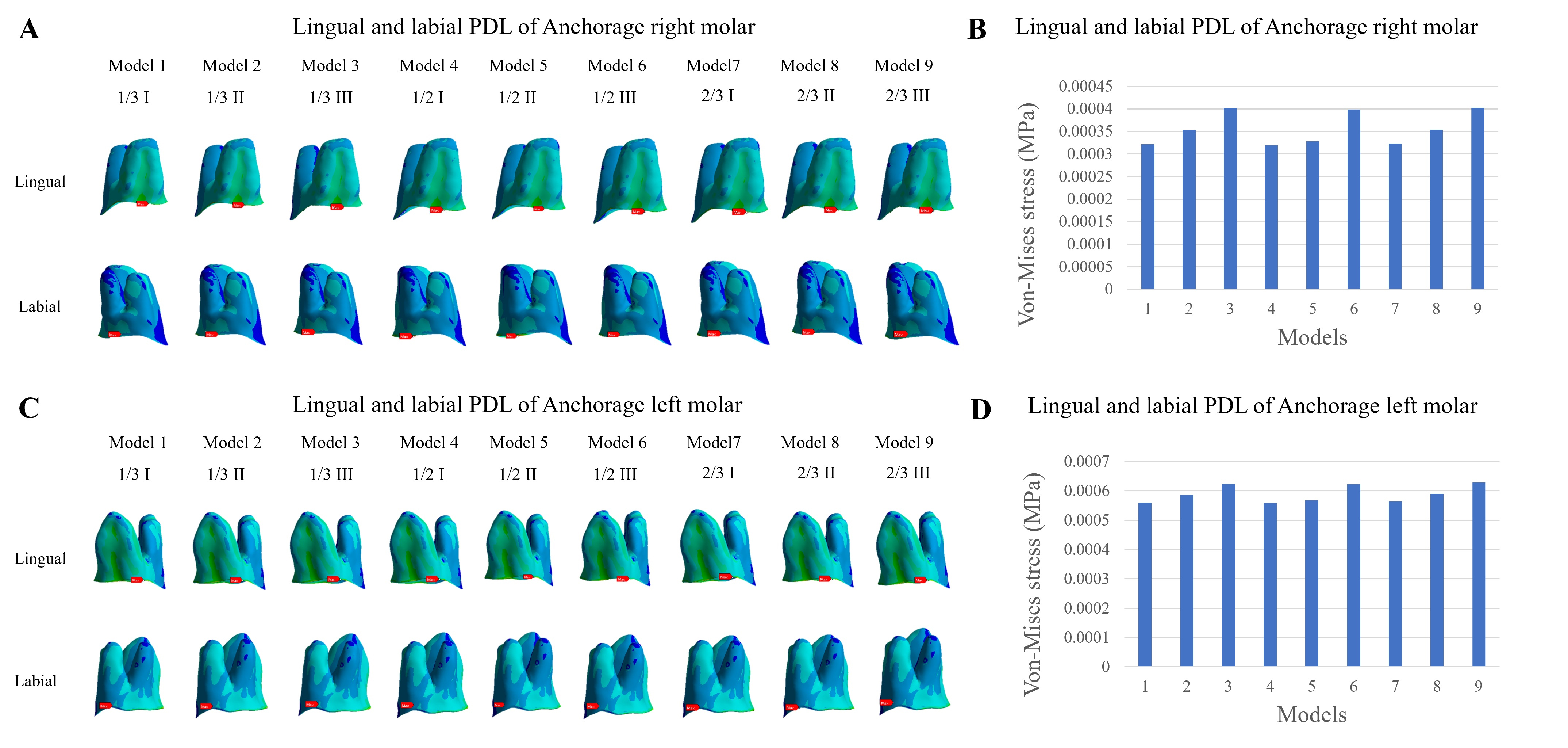 von Mises stress cloud maps (A,C) and values (B,D) in the 
lingual and labial PDL of right and left anchorage molars of 9 three-dimensional 
finite element models. PDL: periodontal ligament.
