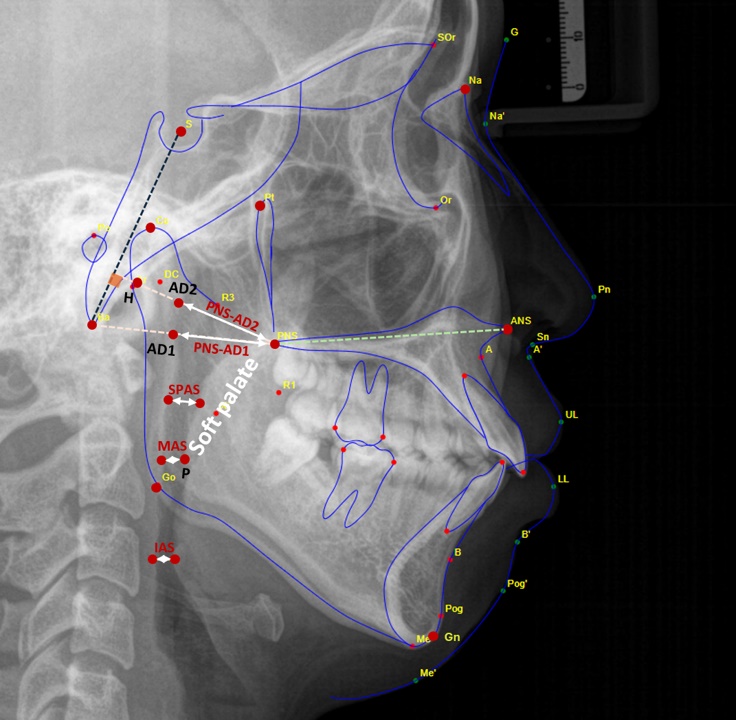 Limitations of airway analyses via lateral cephalometric 
radiography. PNS-AD2 (mm): the distance between PNS and AD2, which is a point on 
posterior pharyngeal wall intersecting the H-PNS line; PNS-AD1 (mm): the distance 
between PNS and AD1, a point on posterior pharyngeal wall intersecting the Ba-PNS 
line; SPAS (mm): the line parallel to the palatal plane between the midpoint of 
PNS and P and the posterior pharyngeal wall; MAS (mm): the line extending to the 
anterior and posterior pharyngeal walls from point P; IAS (mm): the line parallel 
to the palatal plane passing through the anteroinferior point of CV2 and the 
anterior pharyngeal wall. Hormion (H): the cephalometric point located near the 
adenoidal tissue at the cranial base and localized where a line perpendicular to 
the S-Ba line crosses the sphenoid bone. The variations of this point are minimal 
because it is located far away from growth sites (Table 1) [24].
