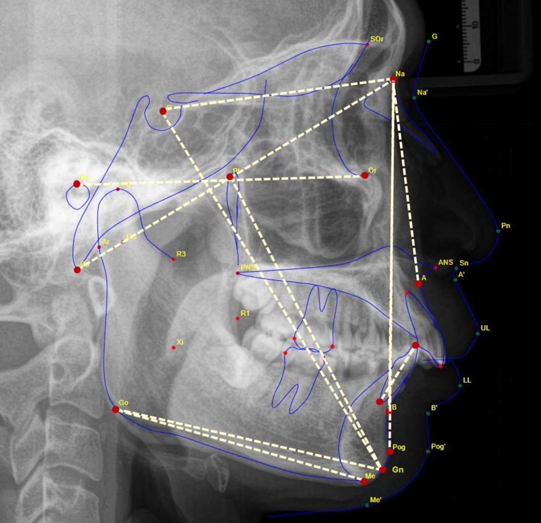 Craniofacial measurements via lateral cephalometric
radiography. SNA (°): Angle between the line Sella-Nasion, and line
Nasion-point A. This angle measures the position of the maxilla relative to the
skull base; SNB (°): Angle between the line point A-Nasion, and line
point Nasion-point B. This angle measures the mandibular’s position relative to
the skull base; ANB (°): Angle between line point A—the Nasion and line
point B—Nasion, indicating the relationship between the maxilla and mandibular;
SN-GoGn (°): the angle between the SN plane and Steiner’s mandibular
plane (Go-Gn); FMA (°): the angle between the Frankfort (FH) plane and
Downs’ mandibular plane (Go-Me). Facial axis (°): the angle between the
Ba-N line and Pt-Gn line; Y-axis (°): the angle between the
S-Gn and FH planes; Facial Angle (°): the angle between
the FH plane and the N-Pog line; L-MP (°): the angle formed by the long
axis of the mandibular incisor and the mandibular plane (Go-Me) (Table 1).
