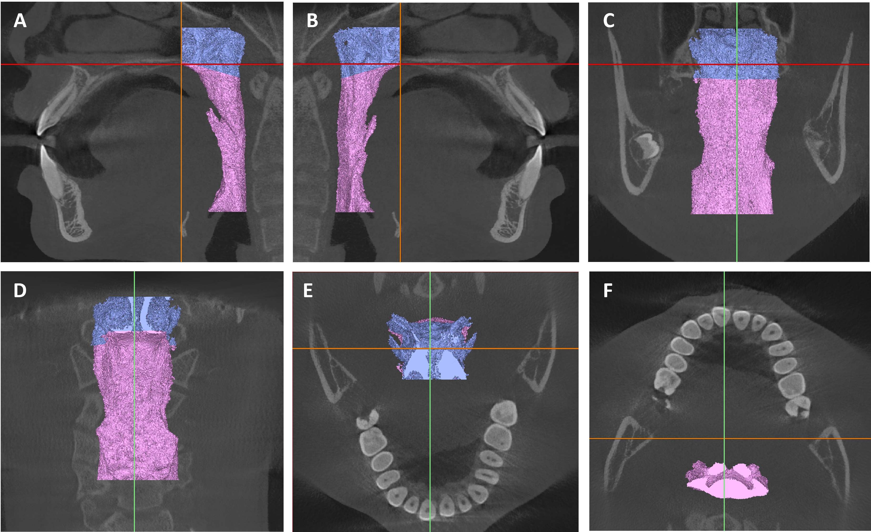Three-dimensional image of the pharyngeal airway. (A) Left; (B)
Right; (C) Anterior; (D) Posterior; (E) Superior; (F) Inferior. The upper airway
extends from the nasal vestibule to the glottis, encompassing the nasal cavity,
nasopharynx, oropharynx and hypopharynx. Airway Boundaries: the anterior region
is defined by the hard palate, mandible and soft palate; the posterior pharyngeal
wall, which stretches from the base of the skull to the level of the cervical
vertebrae, borders the posterior region; superiorly, it is limited by the base of
the skull and the nasal cavity; the inferior region extends to the level of the
epiglottis.