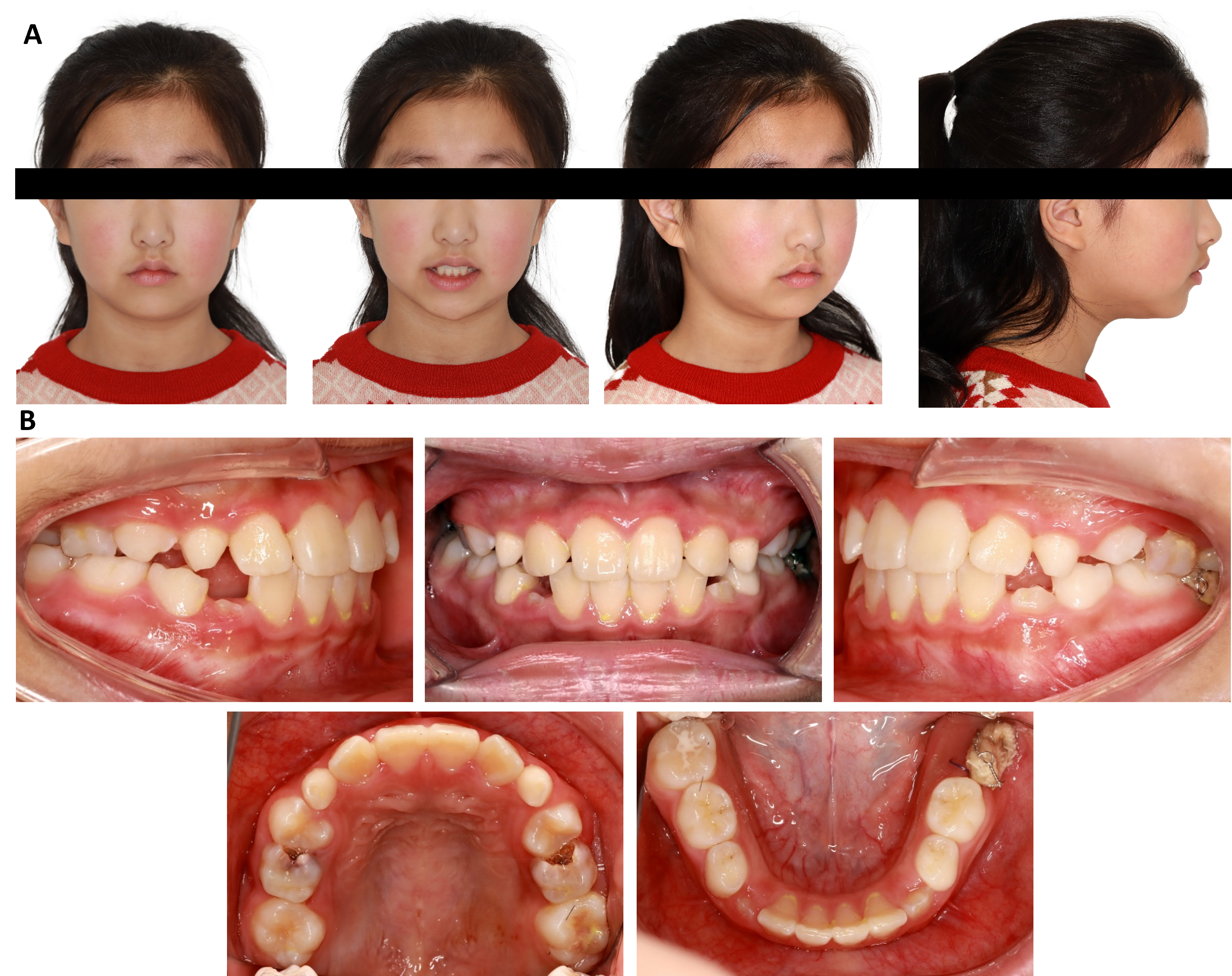 Extraoral and intraoral examinations post-surgery. (A) Extraoral
photographs. (B) Intraoral photographs.