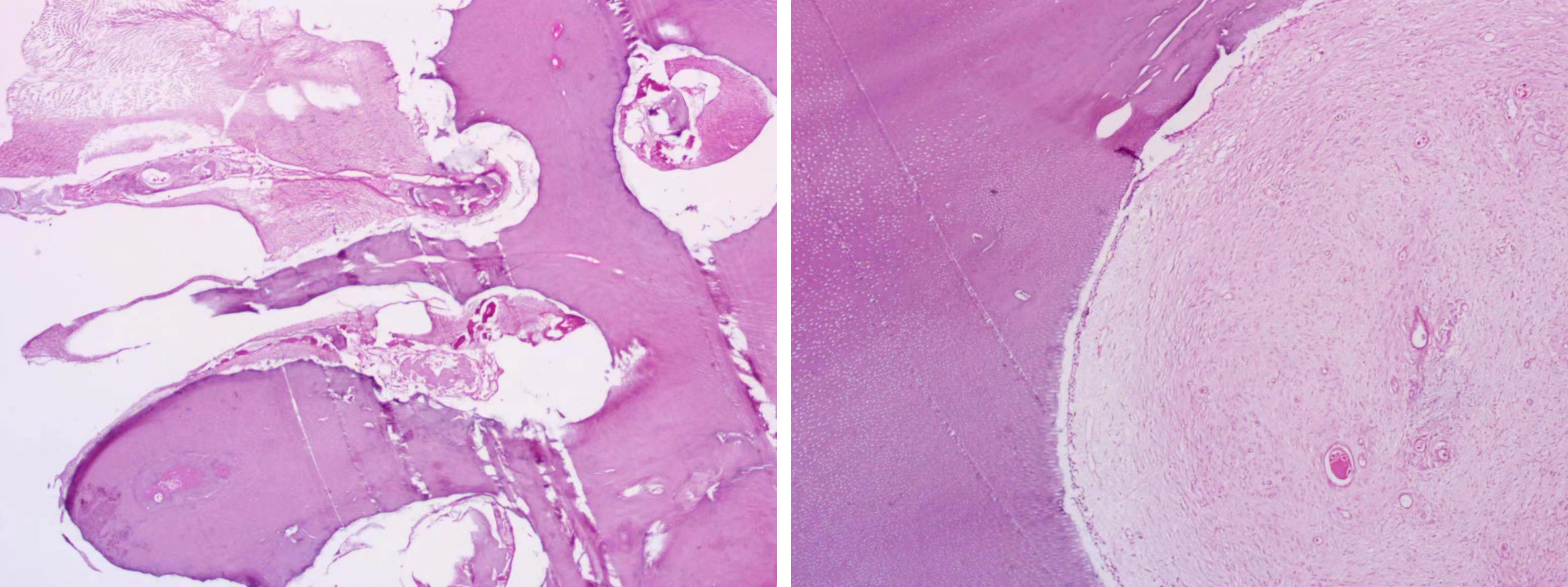 Histopathological examination of specimen of the odontoma.