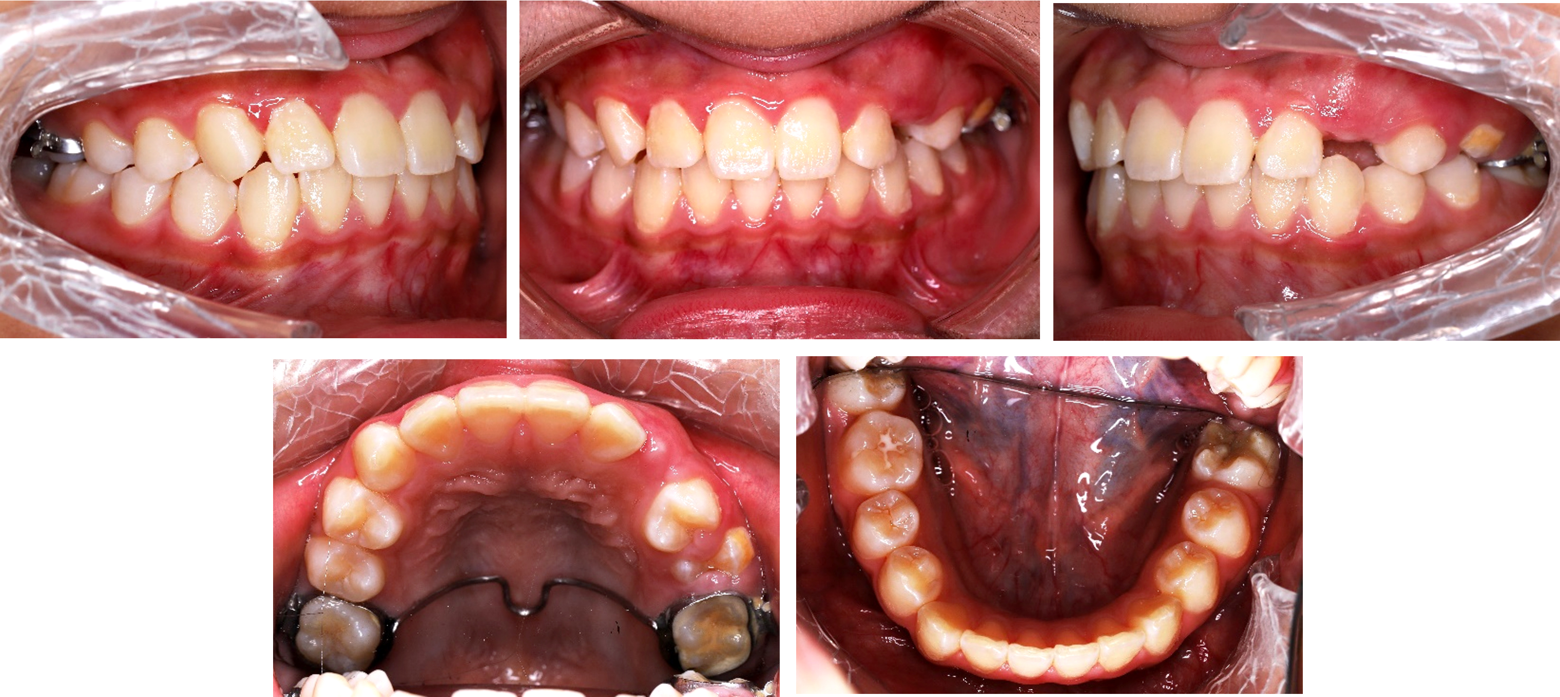 Intraoral photographs at 17-month follow-up after surgery
showing right molar crossbite corrected and a TPA on bilateral maxillary molars.