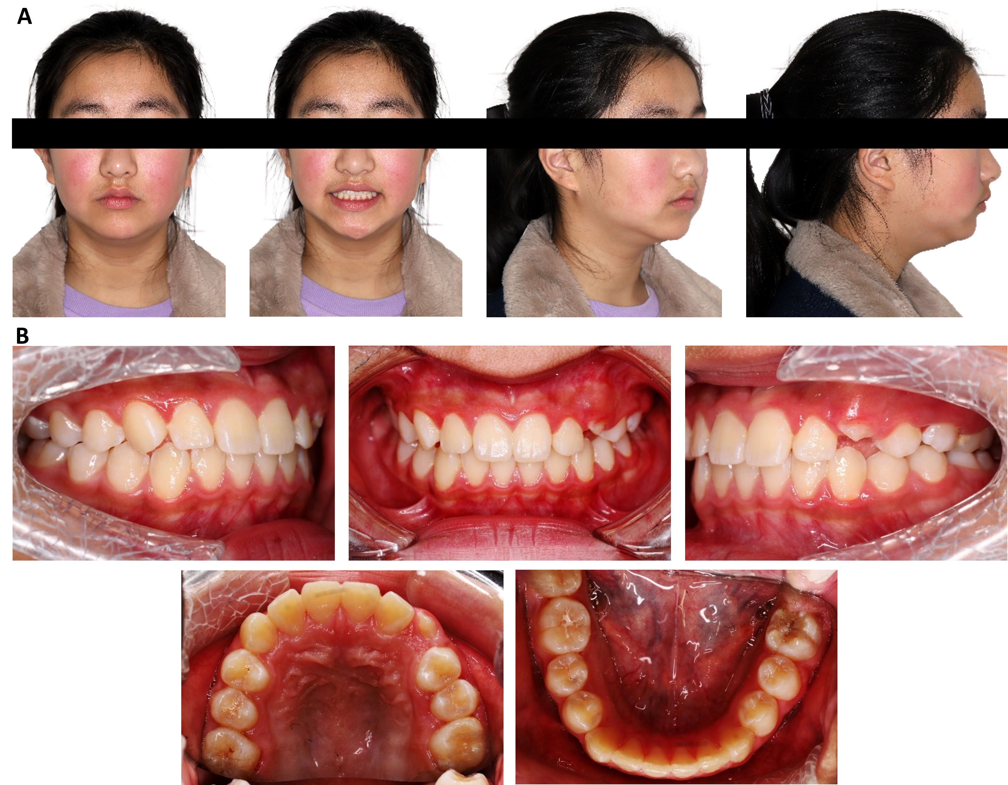 Extraoral and intraoral records at 22-month follow-up after
surgery. (A) Extraoral photographs. (B) Intraoral photographs.