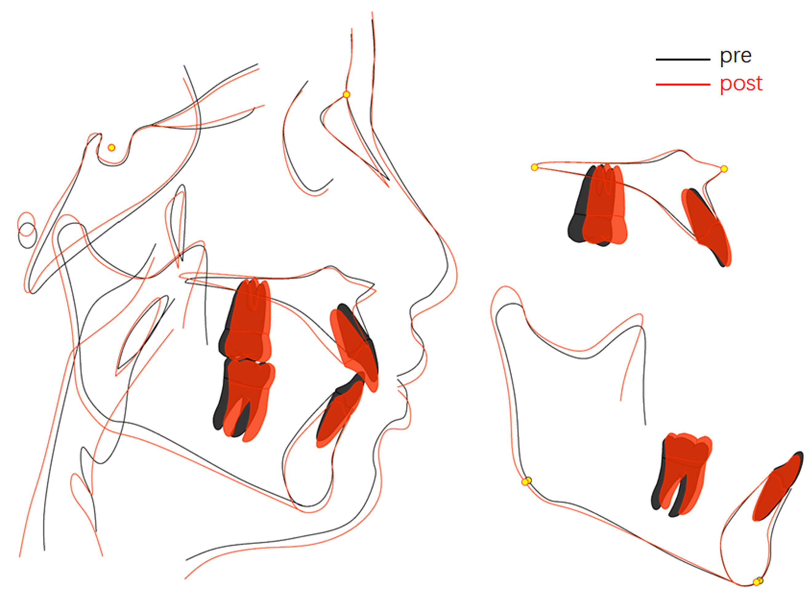 Cephalometric tracing pre- and post-treatment along with
superimpositions.