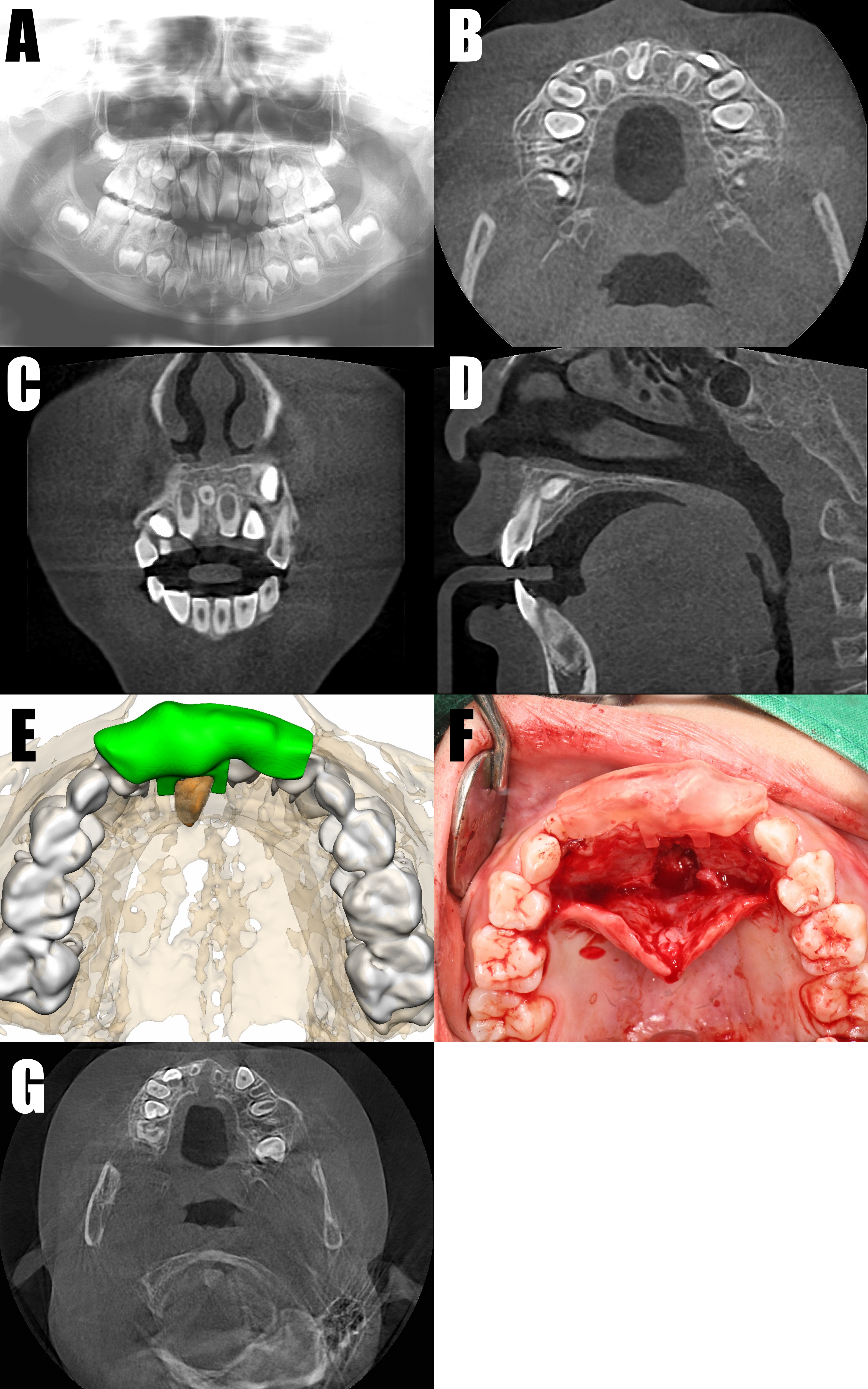 Preoperative panoramic, CT, appliance, clinical photograph,
postoperative CT for case 1. (A) Initial panoramic view. (B) Initial axial view
on CT. (C) Initial coronal view on CT. (D) Initial sagittal view on CT. (E)
Surgical guide model. (F) Intraoperative intraoral photograph. (G) One-week
postoperative CT view. CT: computed tomography.