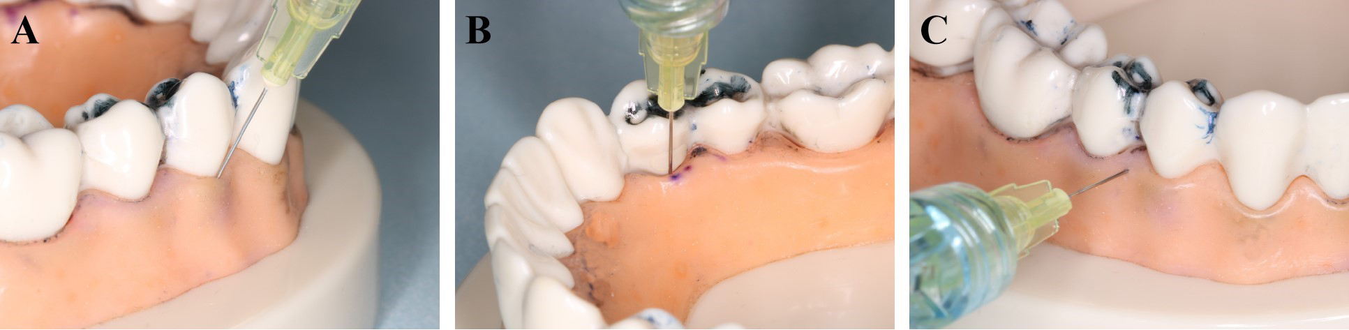 Illustrative figures for different injections types. (A) PL
injection at central buccal side; (B) PL injection at central lingual side; (C)
IS injection.