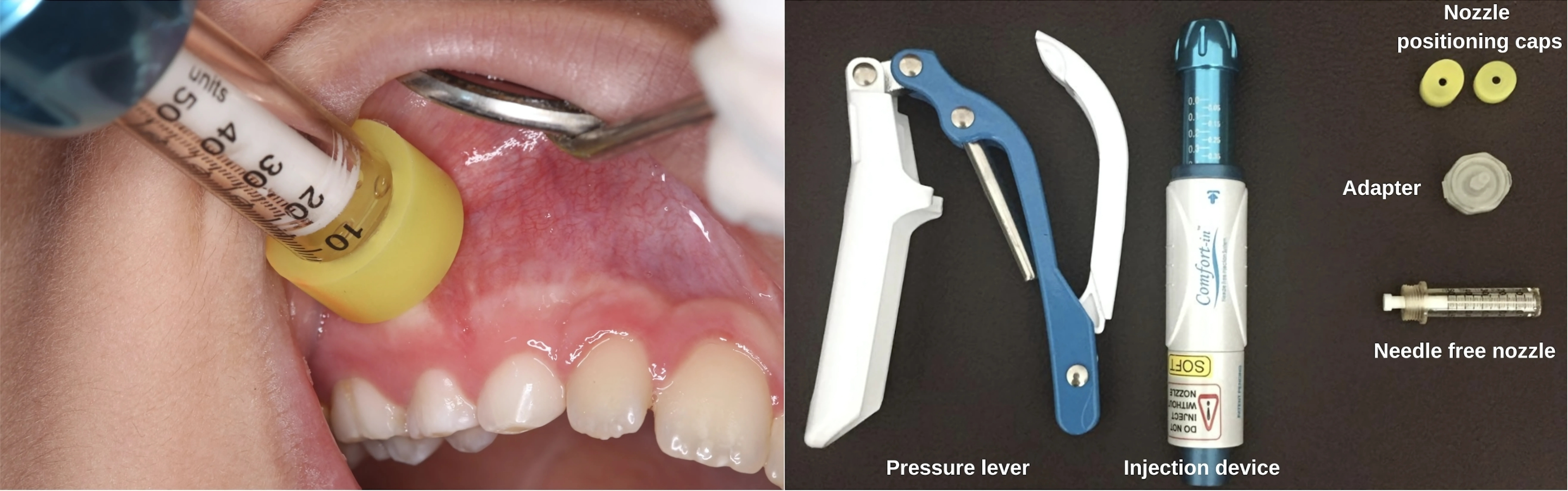 Comfort-in injection system and its intraoral application.