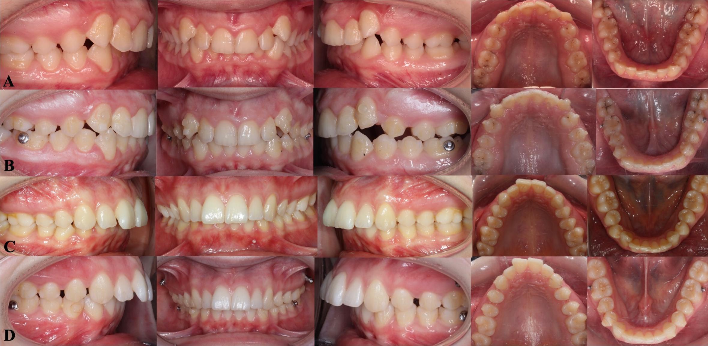 Intraoral photographs of the groups at T0 and T1. 
Intermaxillary elastic group at pretreatment (A), and after the upper second 
premolar distalization completed (B), IZC miniscrew group at pretreatment (C), 
and IZC miniscrew group-after the upper second premolar distalization completed 
(D).