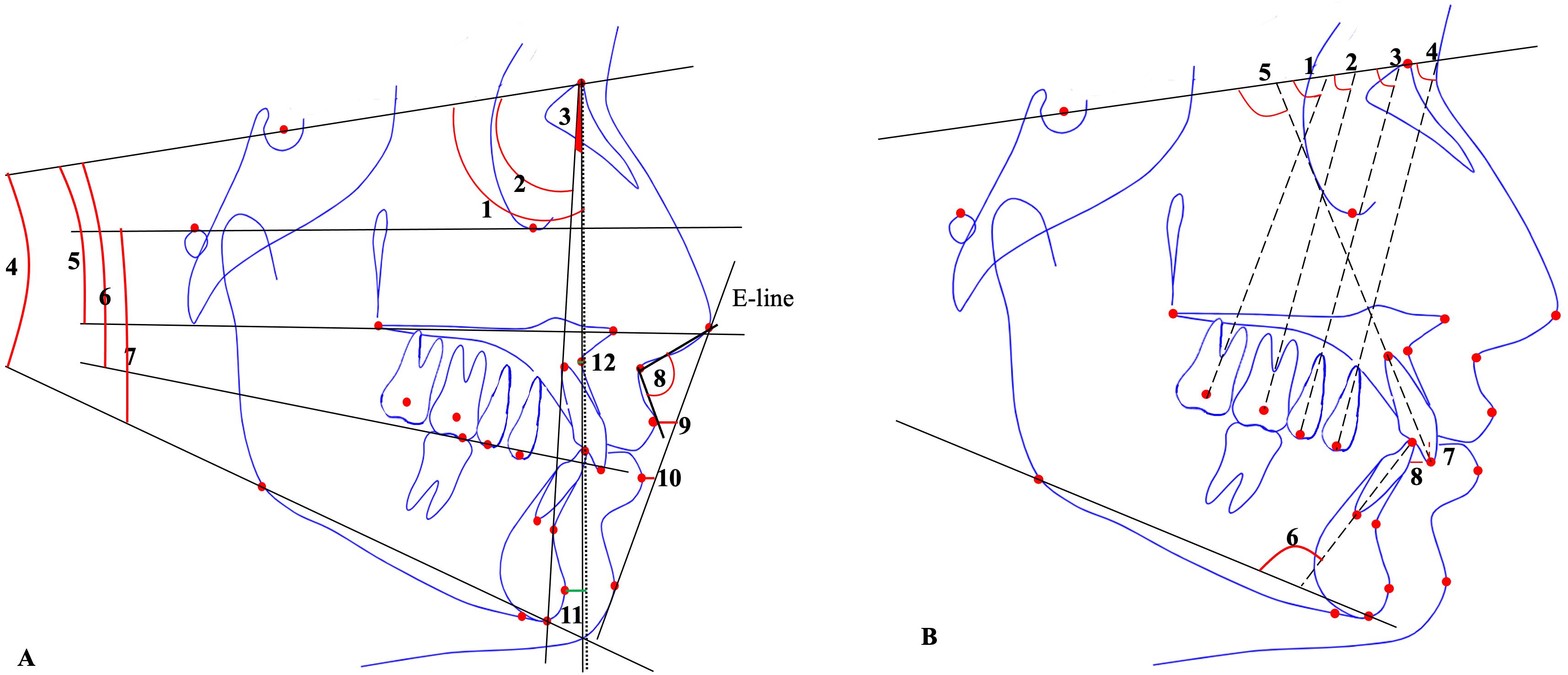 Cephalometric linear and angular measurements were used in this 
study. (A) Skeletal and soft-tissue measurements: 1, SNA (°); 2, SNB 
(°); 3, ANB (°); 4, SN-GoGn (°); 5, SN-PP 
(°); 6, SN-OP (°); 7, FMA (°); 8, Nasolabial angle 
(°); 9, Upper lip to E-line (mm); 10, Lower lip to E-line (mm); 11, 
N-Pog (mm); 12, N-A (mm); (B) Dental measurements: 1, U7-SN 
(°); 2, U6-SN (°); 3, U5-SN (°); 4, U4-SN 
(°); 5, U1-SN (°); 6, MP-L1 (°); 7, Overbite (mm); 8, 
Overjet (mm). (U7, maxillary second molar centroid; U6, maxillary first molar 
centroid; U5, maxillary second premolar buccal cusp tip; U4, maxillary first 
premolar buccal cusp tip; U1, maxillary incisor tip; L1, mandibular incisor tip; 
MP, mandibular plane.)