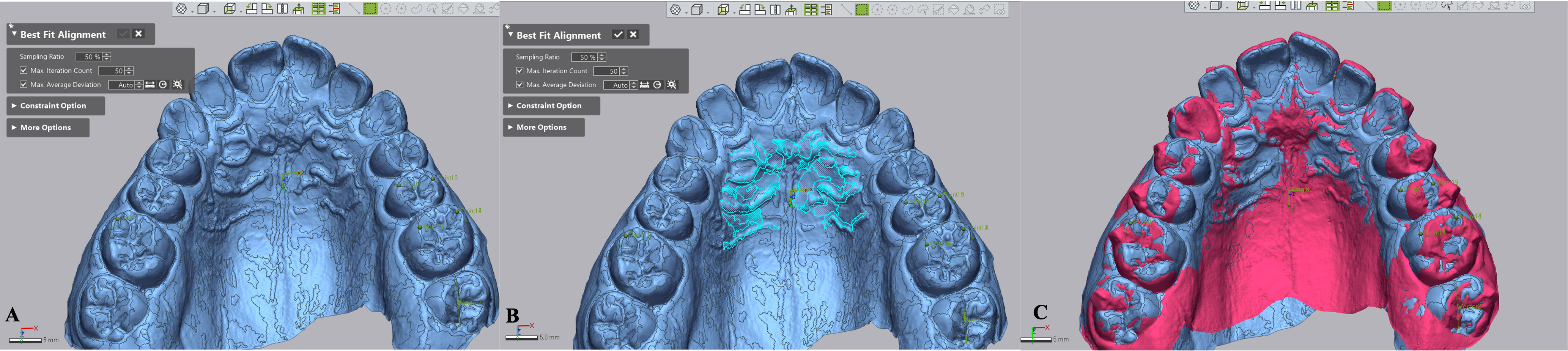 Superimposition of digital models. (A) Pretreatment model (T0) is referred to as the “reference model”. (B) A 
reference area in the palatal region for the model superimposition. (C) Superimposition of pretreatment and posttreatment models. Blue, 
pretreatment-reference model (T0); Pink, achieved outcome-measured model 
(T1).